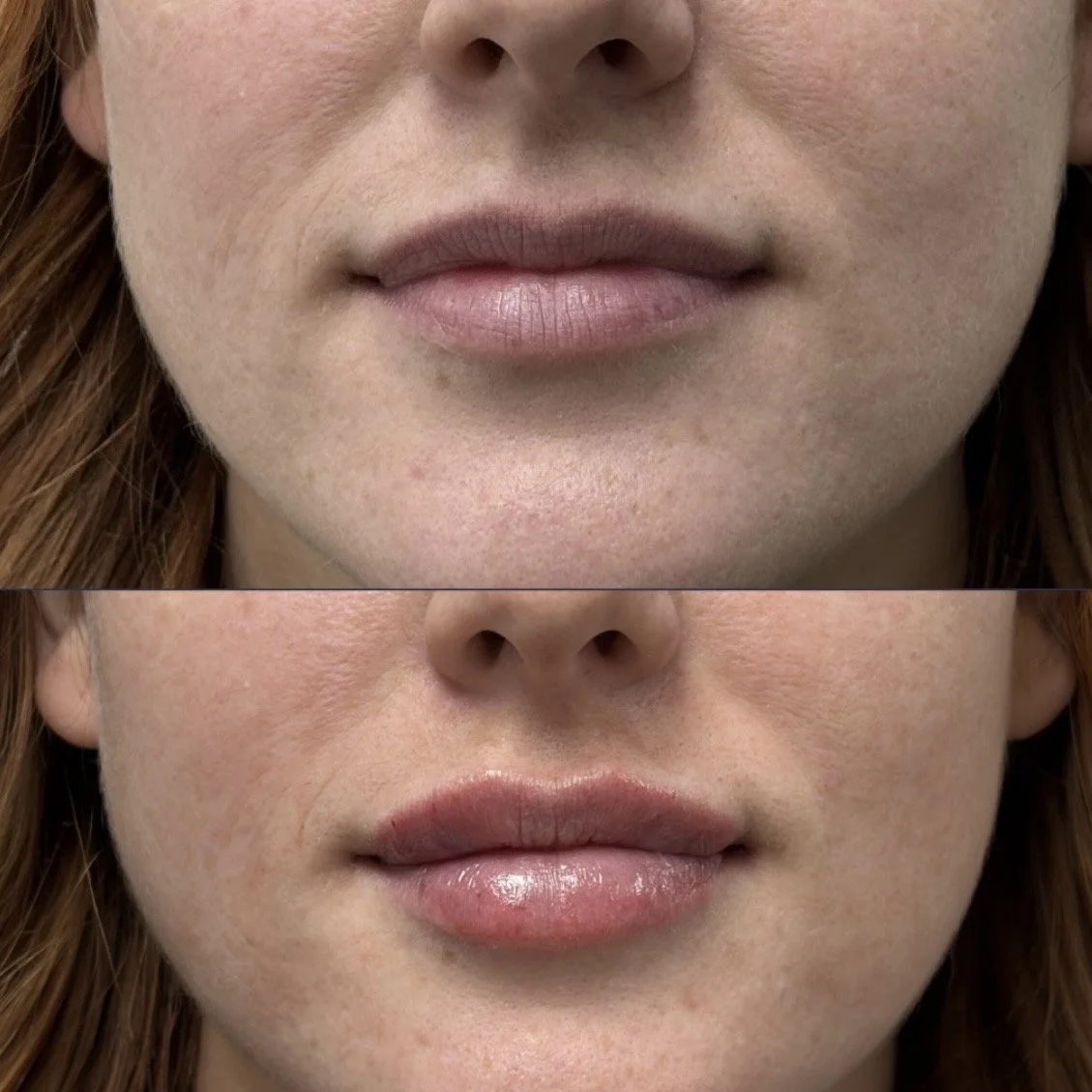Lip Filler in Red Deer: A Refined Approach 