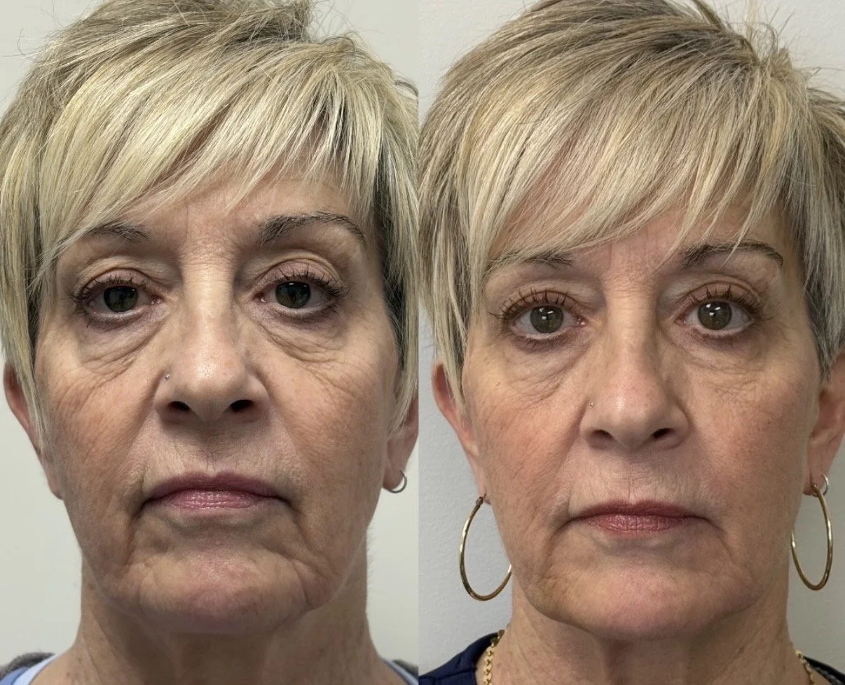 Natural dermal filler before and after results in Red Deer Alberta showing subtle cheek and lip enhancement