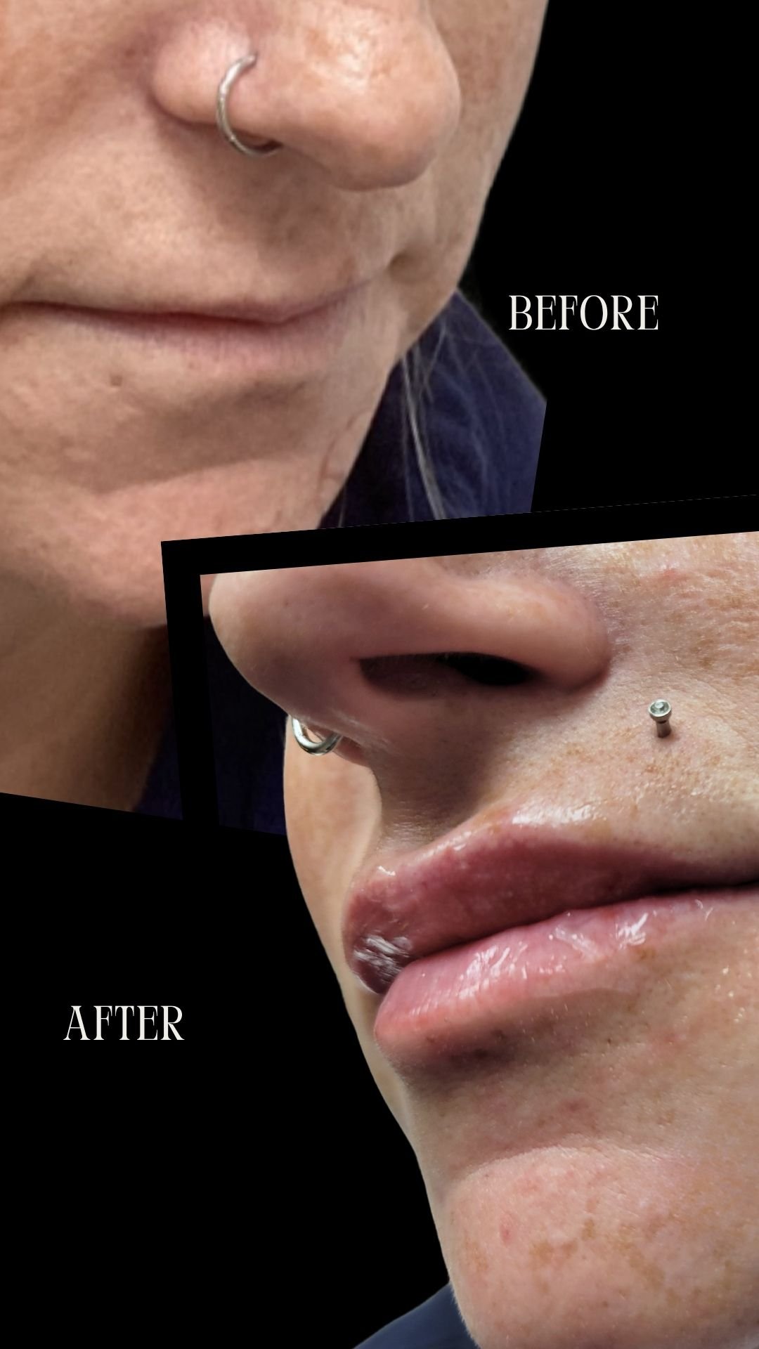 Lip Filler with Juvederm Ultra XC