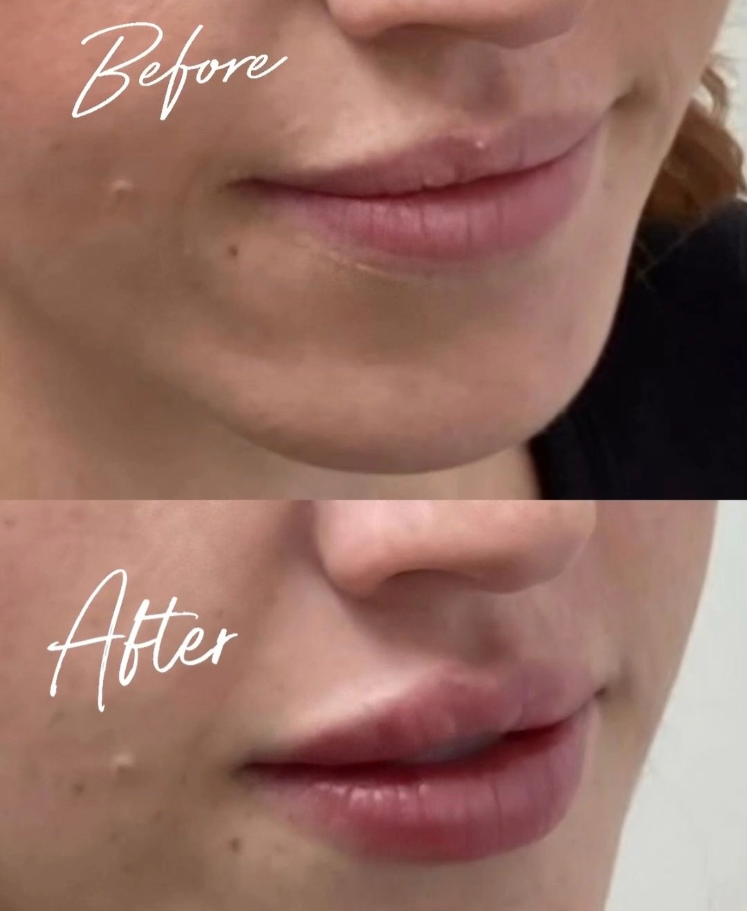 Comparison of lips before and after cosmetic lip enhancement, showing fuller lips in the after image.