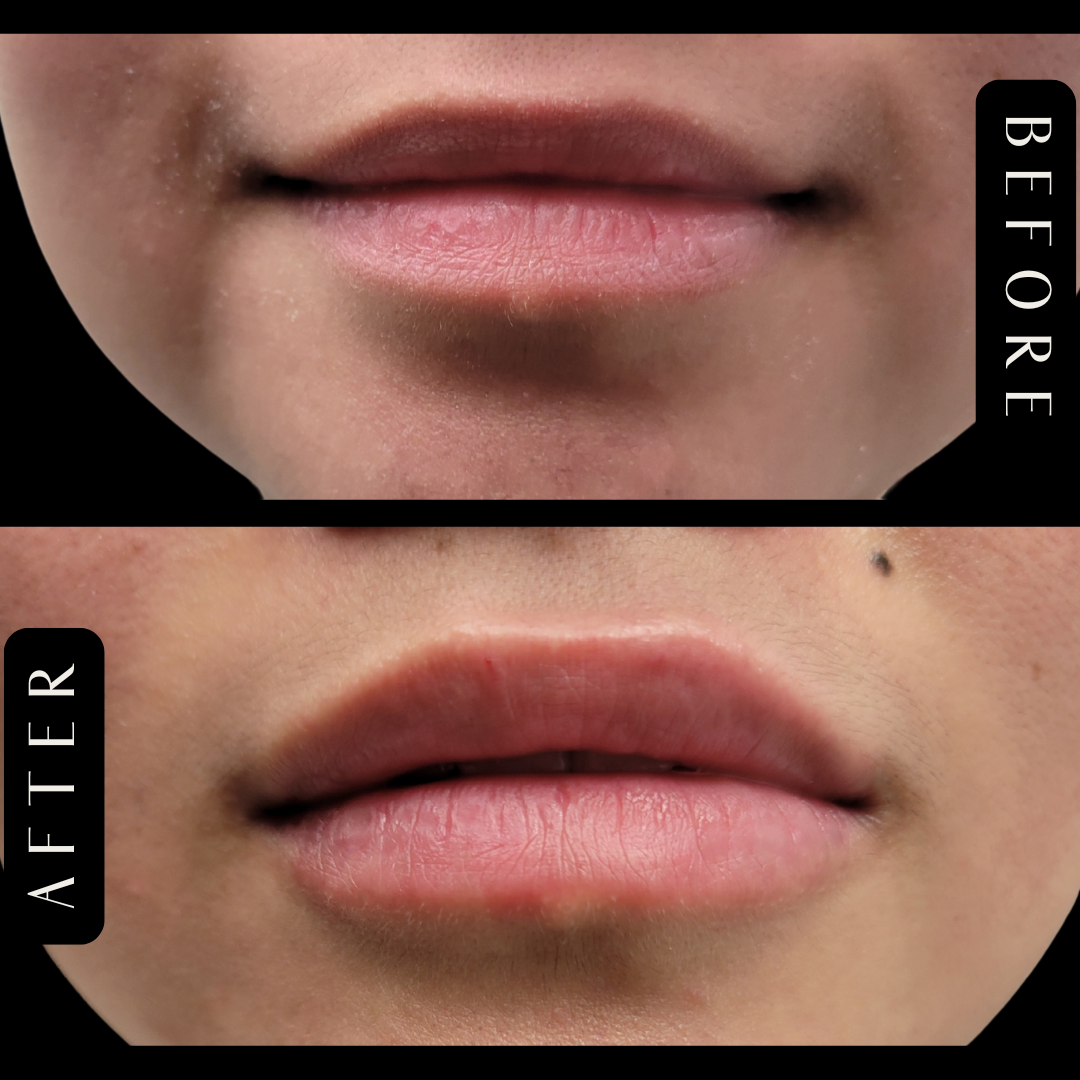 Lip Filler with Restylane Kysse