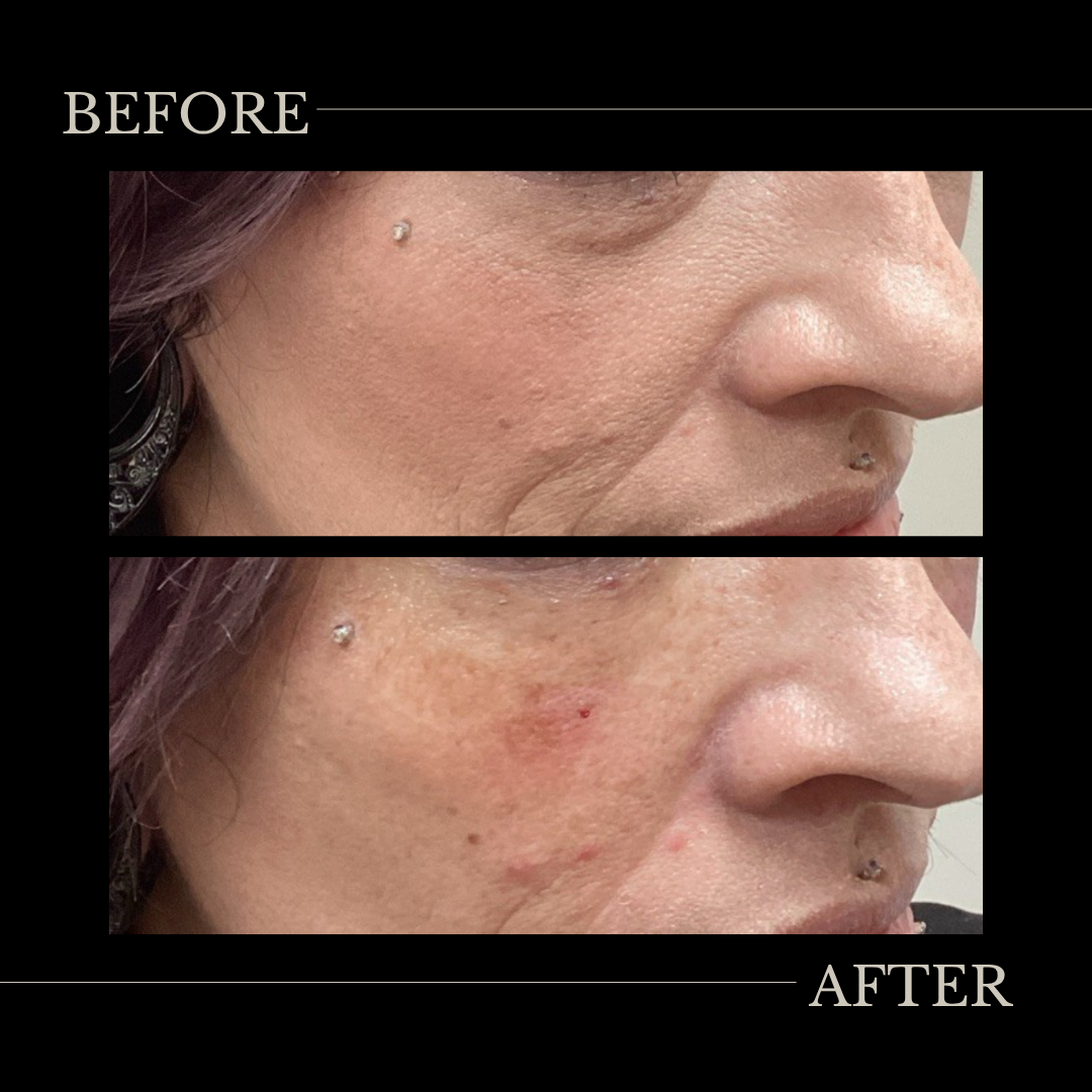 Undereye Filler with Belotero Balance.