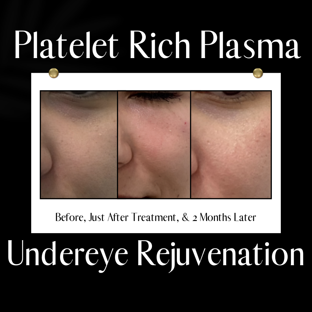 PRP (Platelet Rich Plasma) Undereye injections for a natural way to rejuvenate tired eyes and stimulate long term collagen repair.