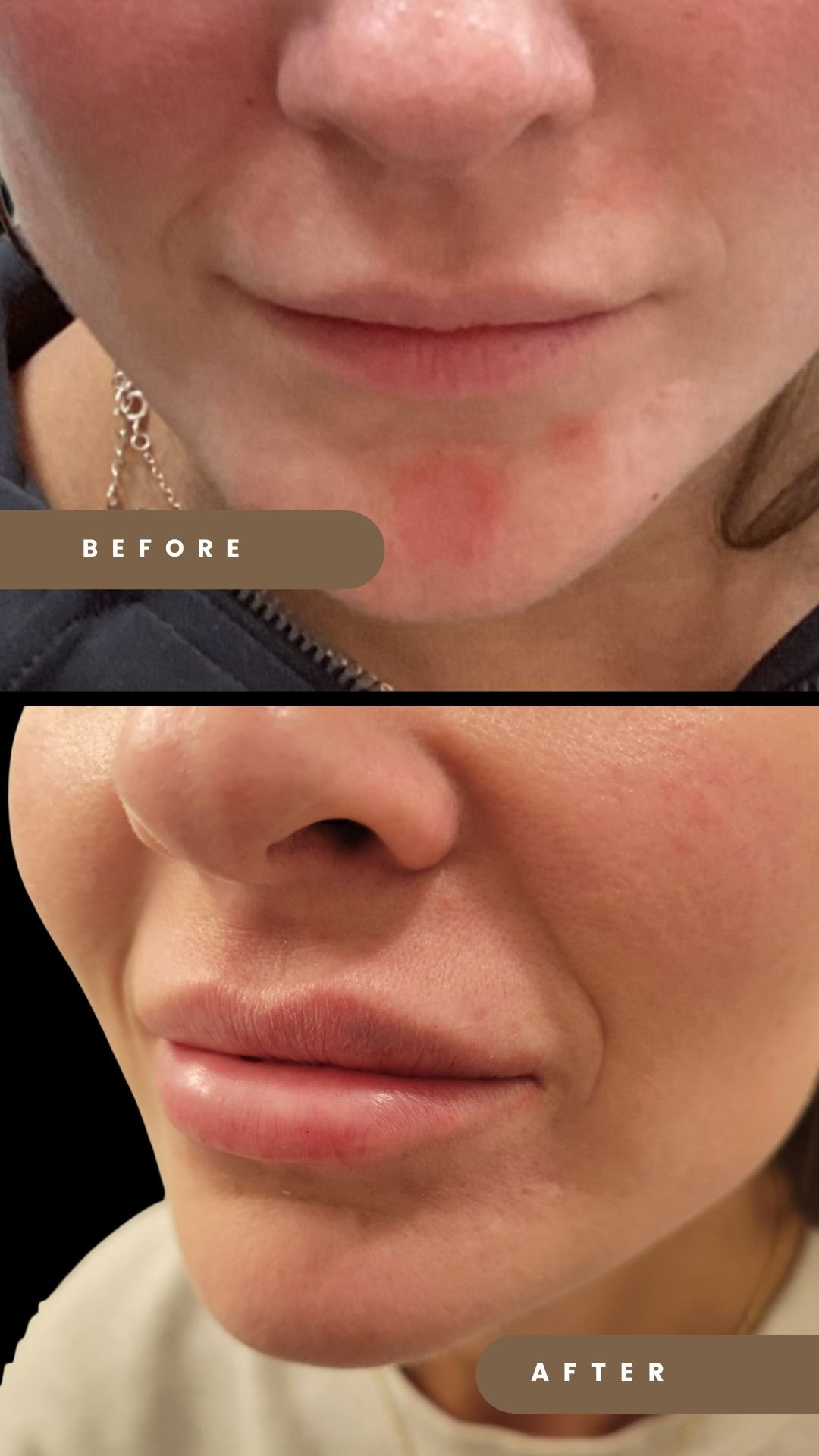 Lip Filler with Juvederm Ultra XC