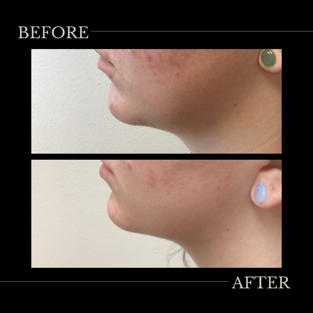 Kybella® under chin and jowls fat dissolving after 3 treatments.