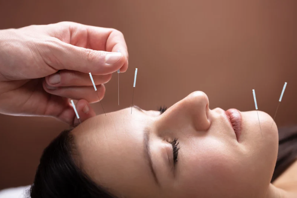 A patient receiving acupuncture for migraine headaches.