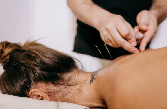 A lady recieveing acupuncture to help calm anxious thoughts