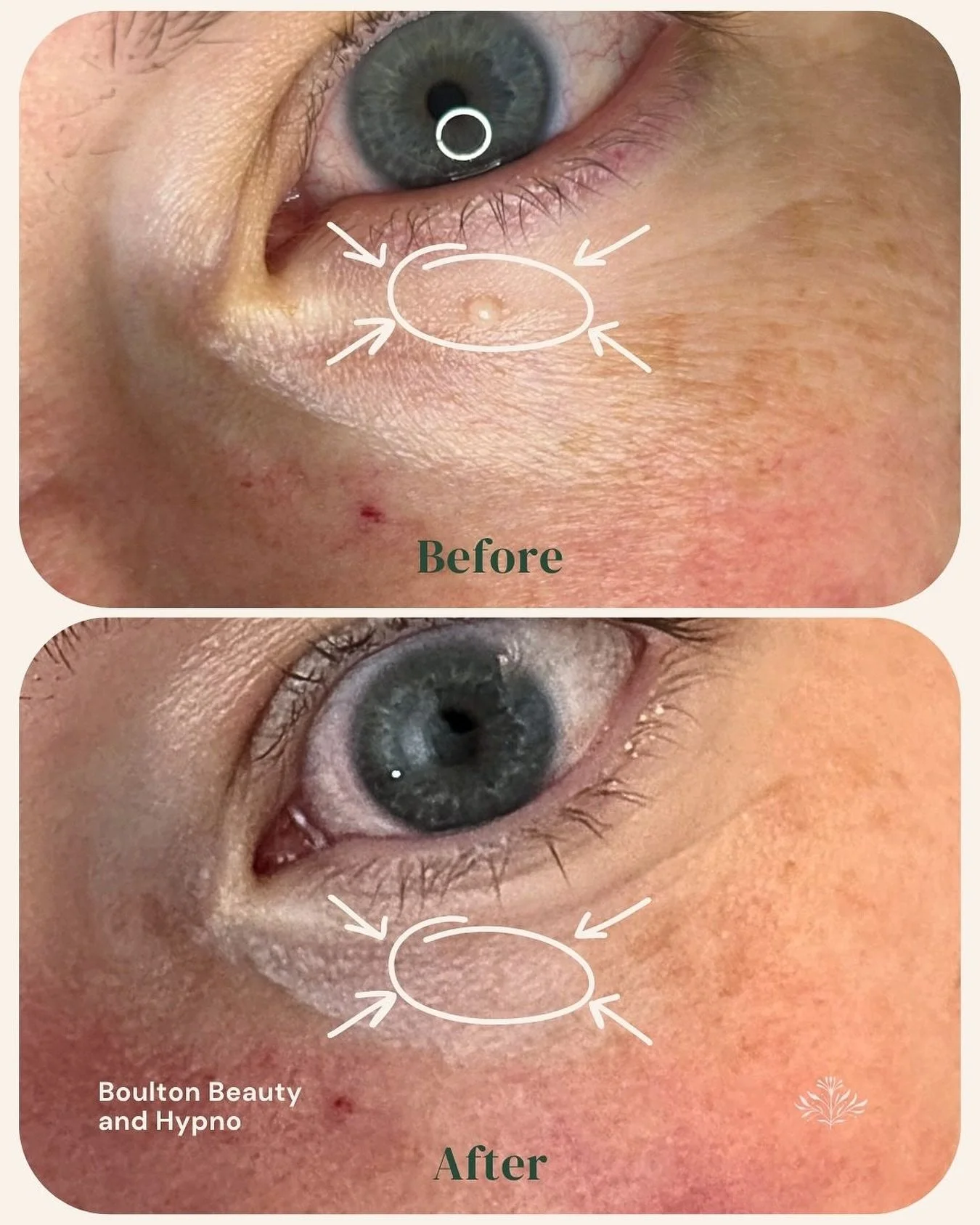 Real transformation isn&rsquo;t just about what you see &mdash; it&rsquo;s what you feel.💚

Take a look at one of my recent clients transformations! So happy with the outcome. Whether it&rsquo;s through hypnosis or skincare, the goal is the same: pe