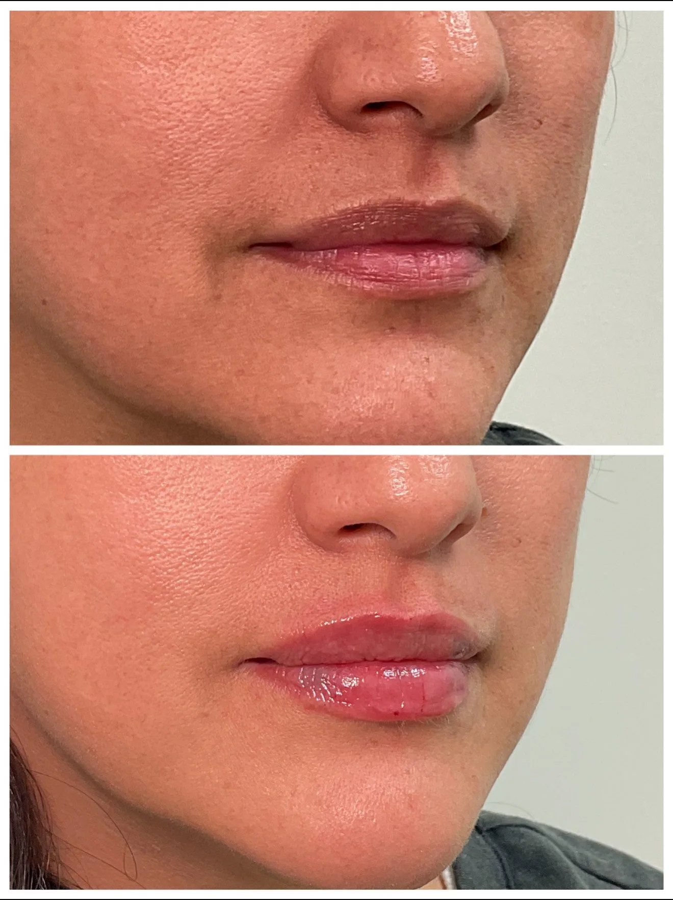 Close-up comparison of a woman's lips and surrounding skin before and after applying lip gloss, showing smoother and shinier lips in the after image.