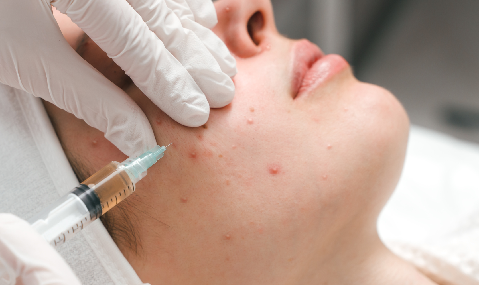 Person receiving an acne injection in the cheek from a healthcare professional wearing gloves.