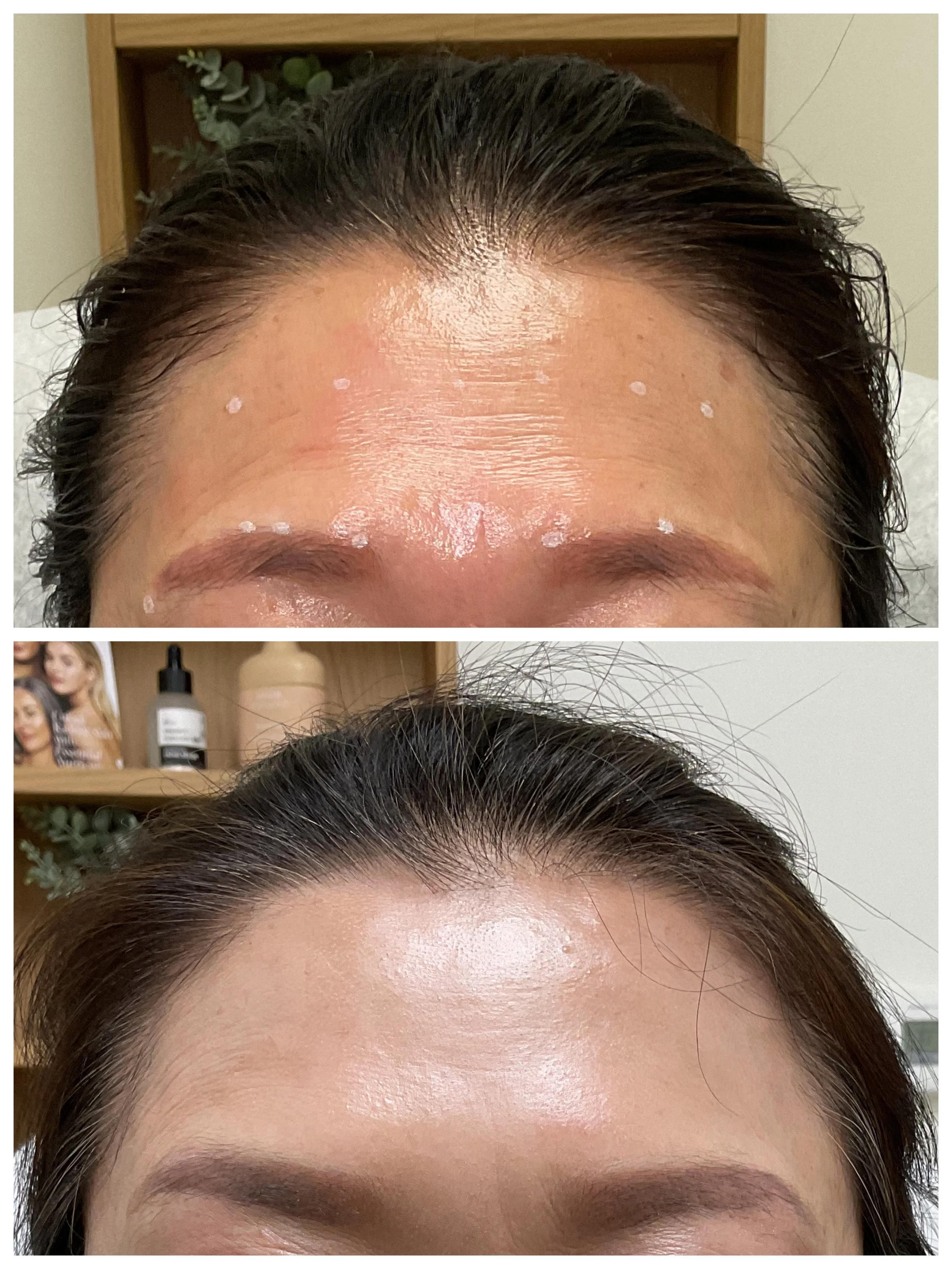 Comparison of a woman's forehead before and after Botox treatment, showing reduced wrinkles and smoother skin.