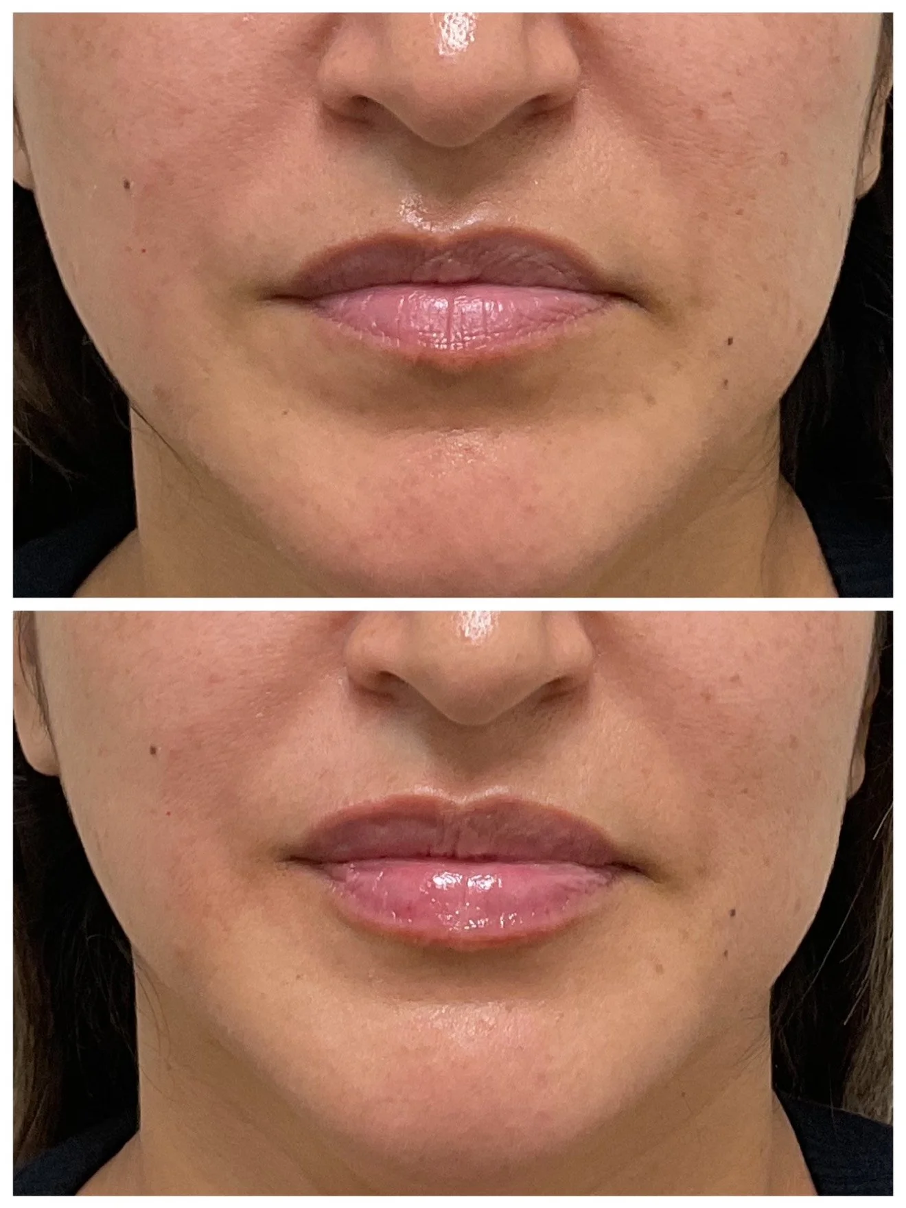 Close-up of a woman's lips and chin showing before and after cosmetic treatment with smoother skin and plumper lips in the second image.