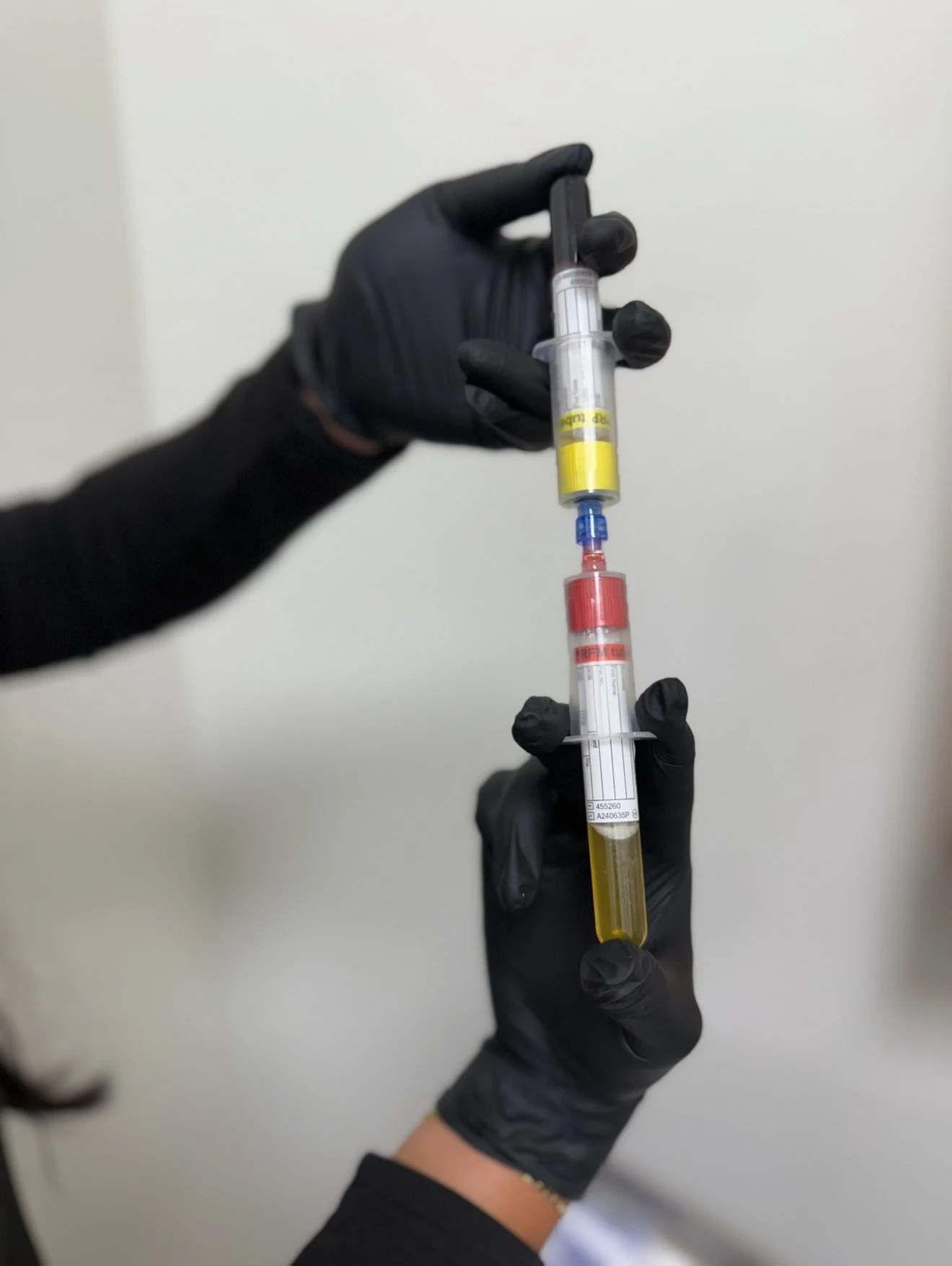 Two gloved hands holding medical syringes filled with yellow and red liquids.