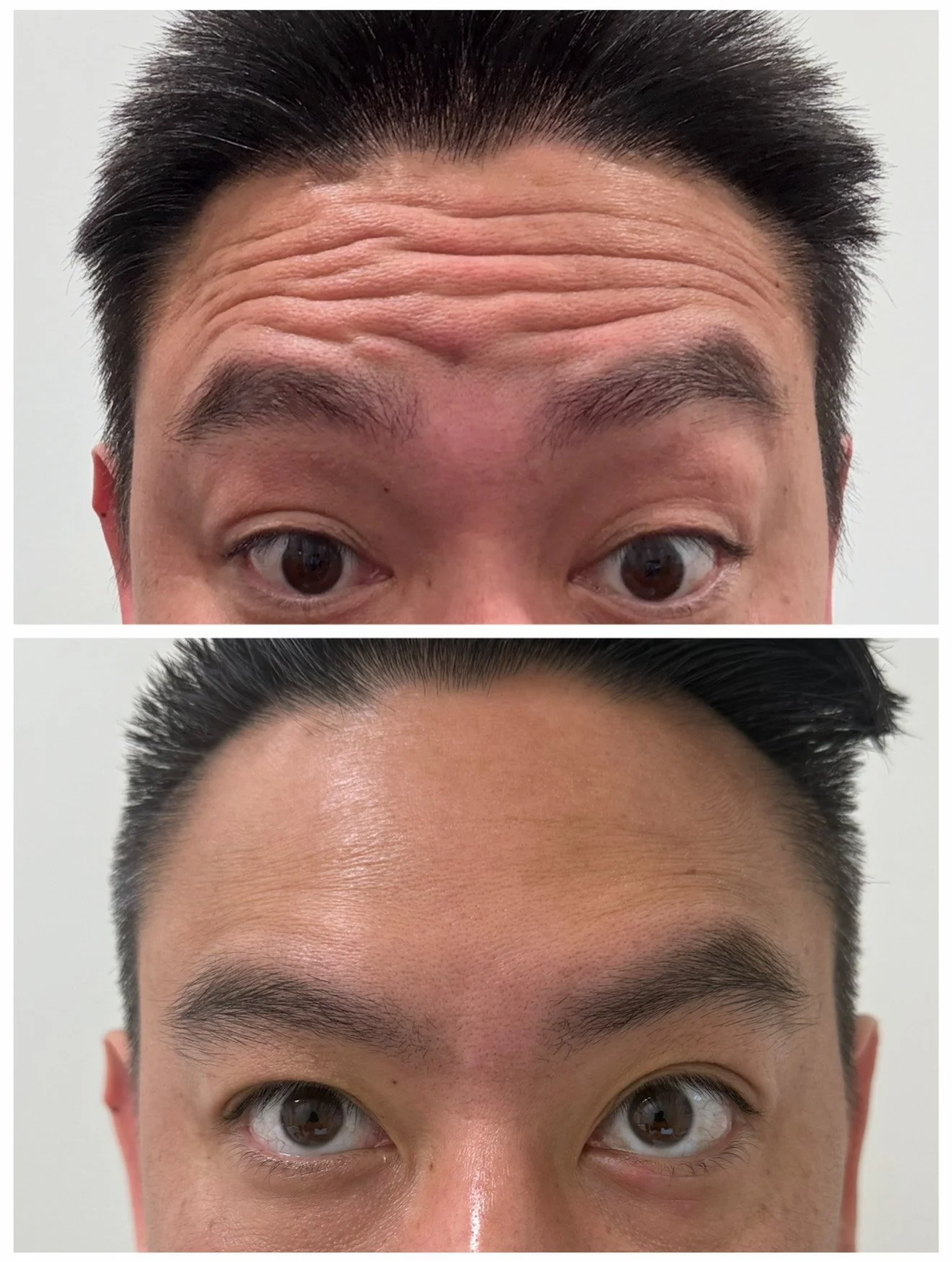 Comparison photo showing forehead wrinkles before and after cosmetic treatment. Top image shows forehead with multiple horizontal wrinkles, bottom image shows smoother forehead.
