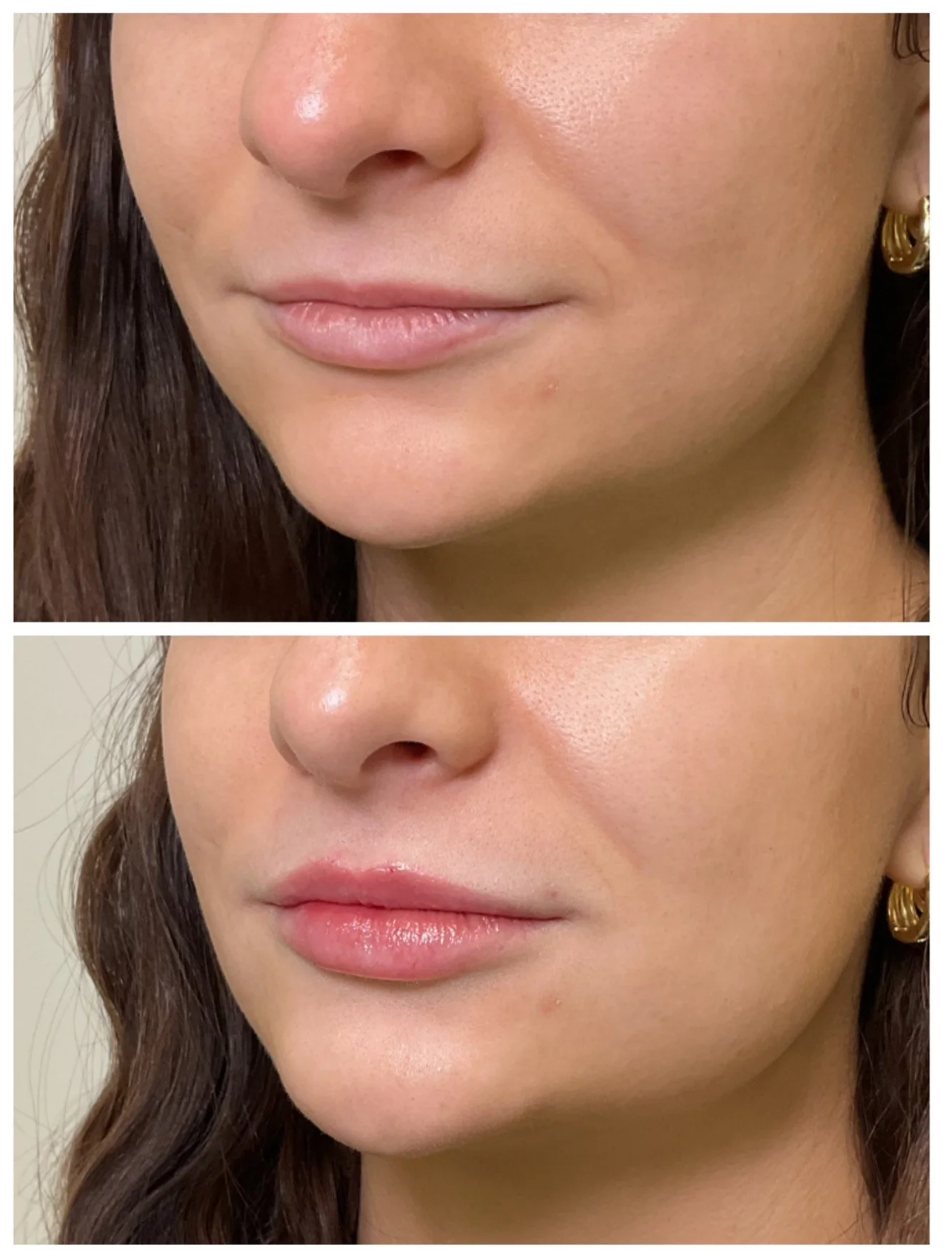 Close-up images of a woman's face showing a before and after of lip enhancement. The top image shows natural lips, while the bottom image shows slightly fuller, glossed lips.