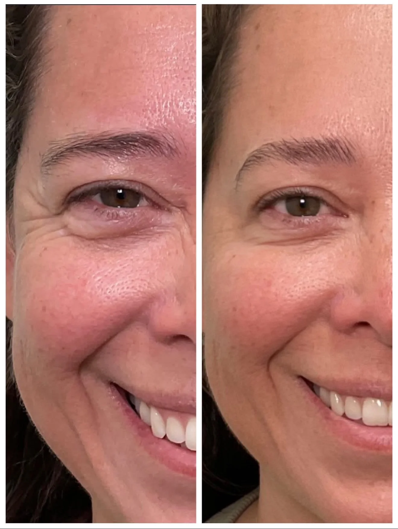 Comparison of a woman's face showing a close-up of the eye and cheek area before and after a cosmetic treatment, highlighting reduction in wrinkles and improved skin texture.
