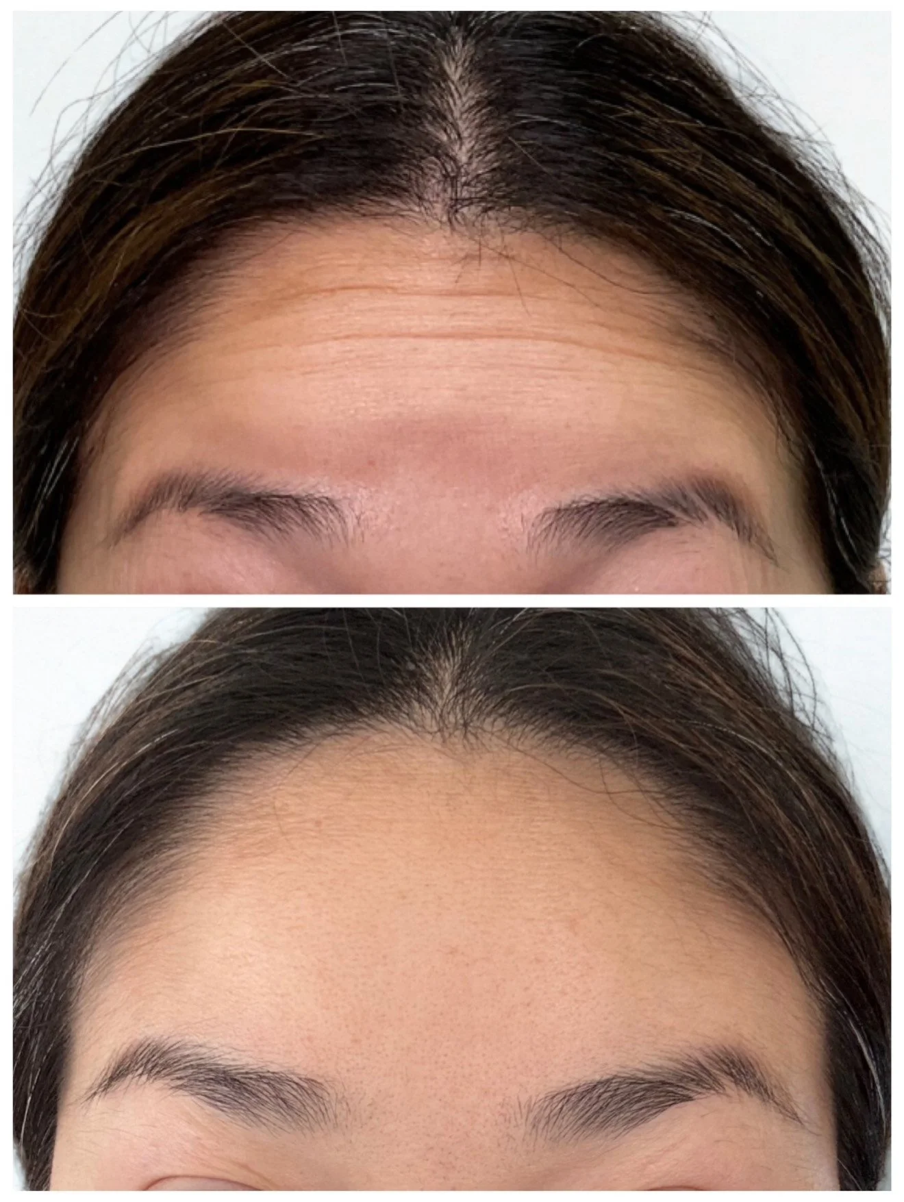 Close-up of a person's forehead showing a before-and-after comparison of skin condition, with smoother, clearer skin in the after image.