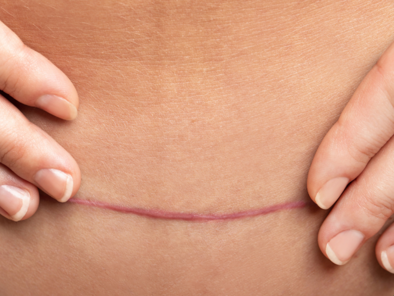 c-section scar