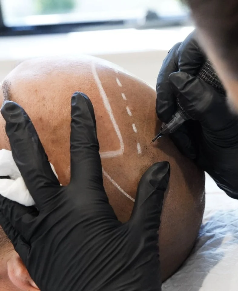 receding hairline restoration SMP