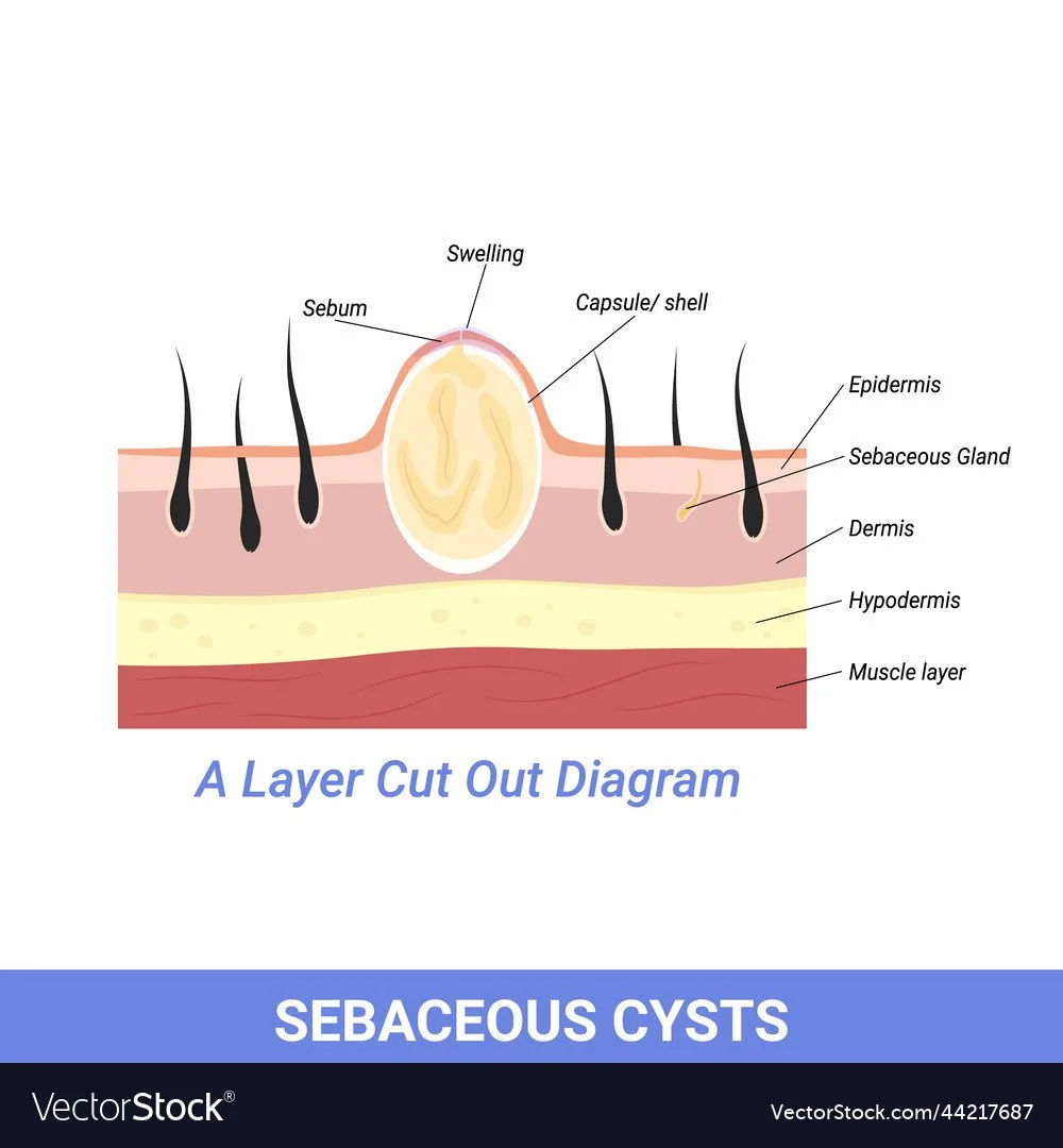 My Cyst Experience — The Frankly