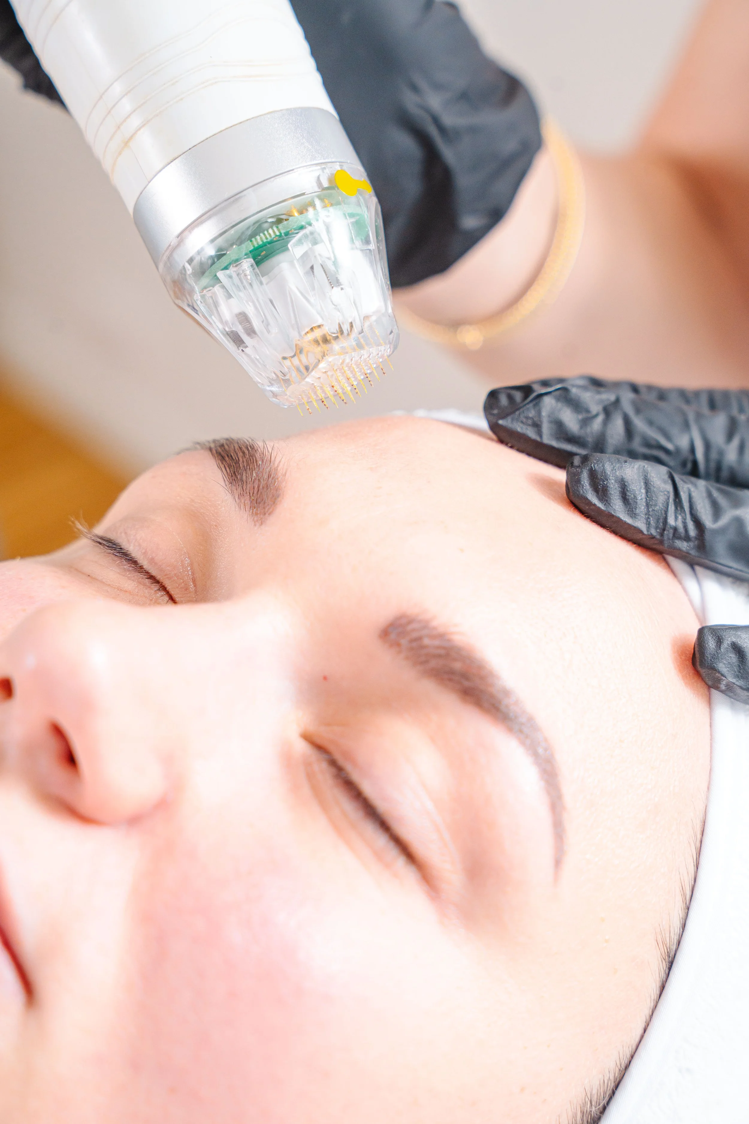 Personne traitement microneedling avec DeAge EX chez B-Beautiful maison de beauté à Genève