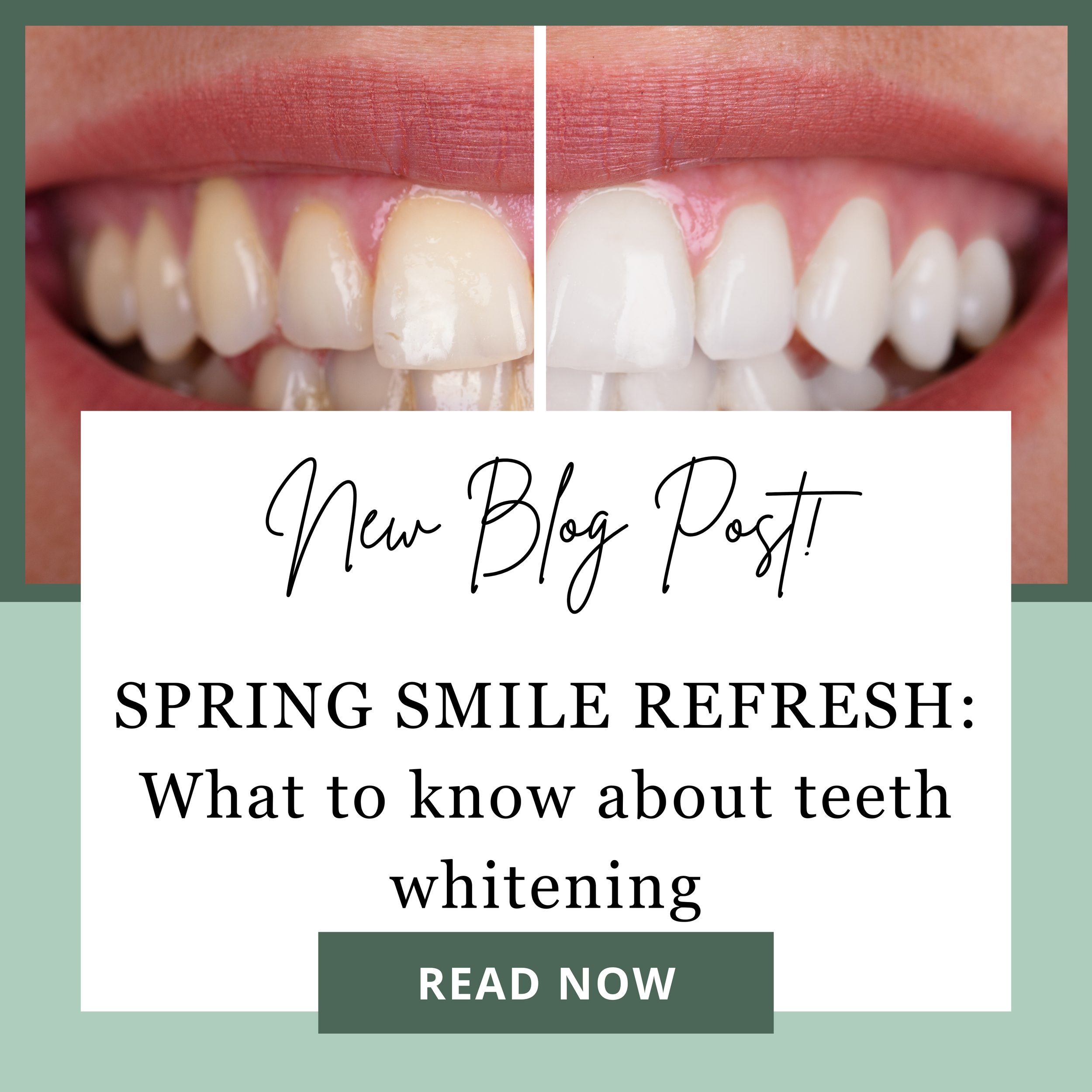 Is Teeth Whitening Right for You This Spring?