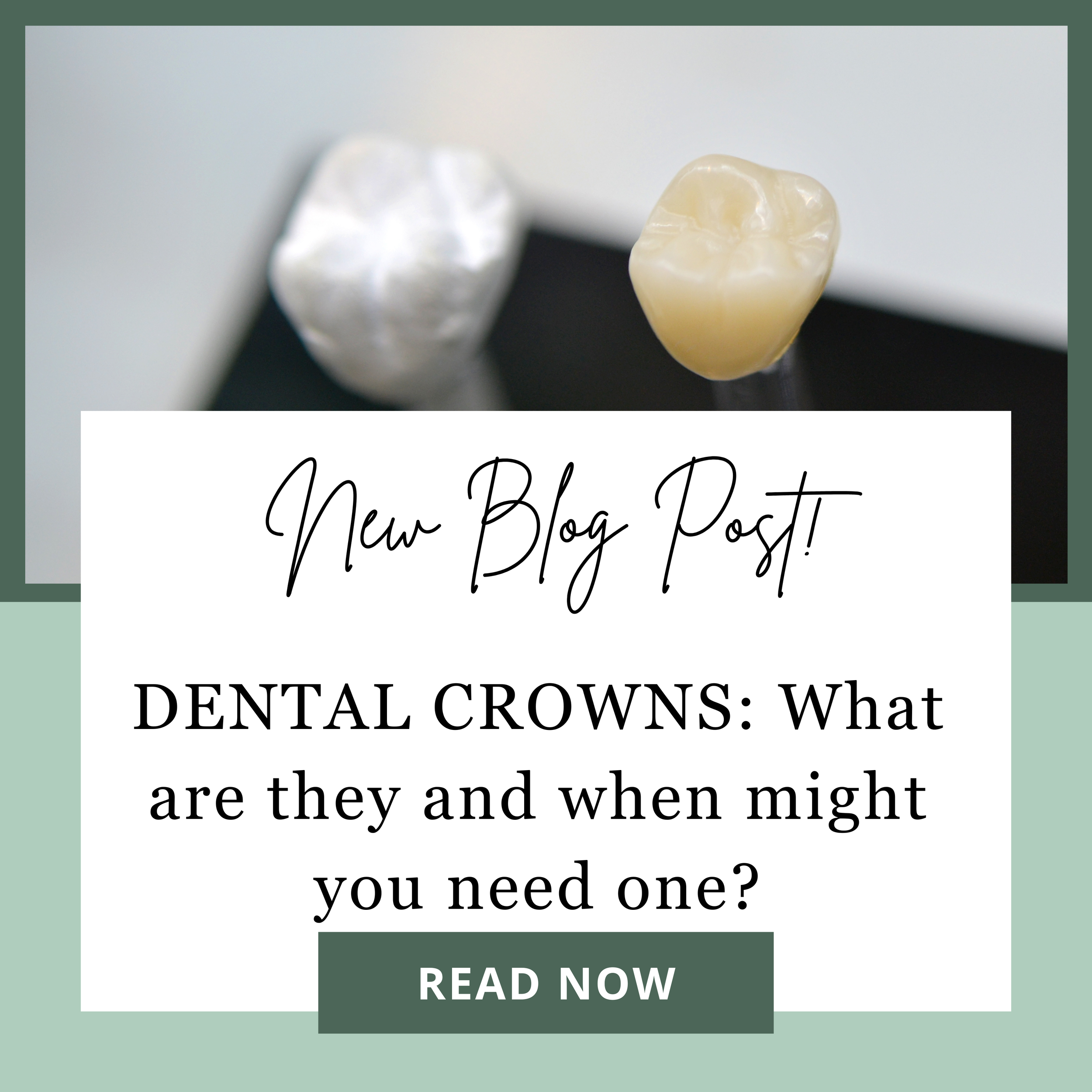 Dental Crowns: What Are They and When Might You Need One?
