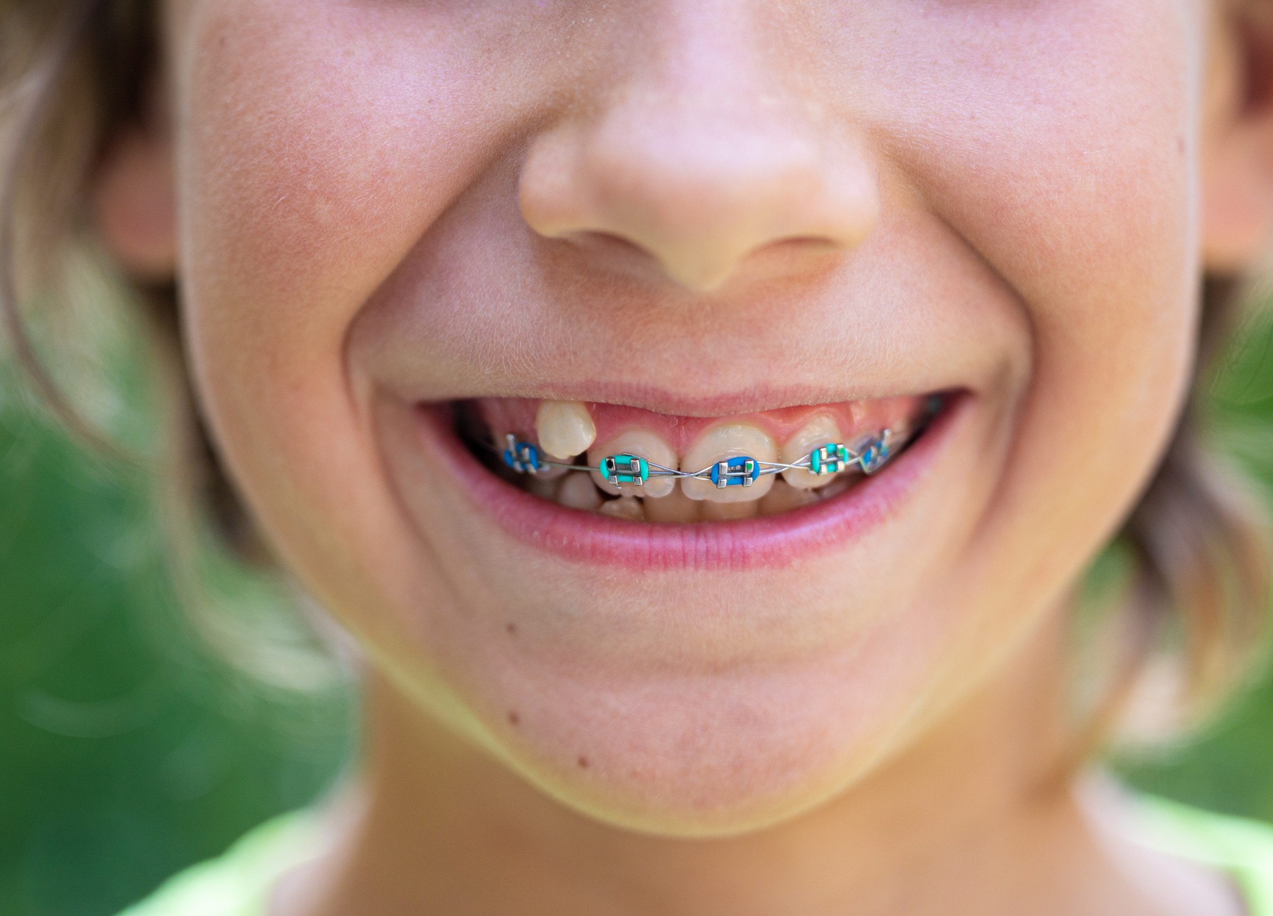 Orthodontic care at Luce Line Family Dental