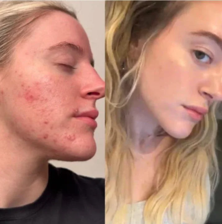 Comparison of a woman's face before and after acne treatment showing clear skin in the after photo.