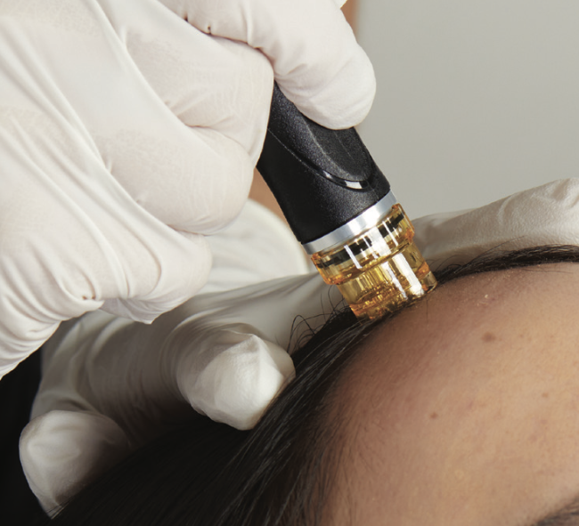 A person receives a scalp treatment with a handheld device on their forehead, wearing gloves.