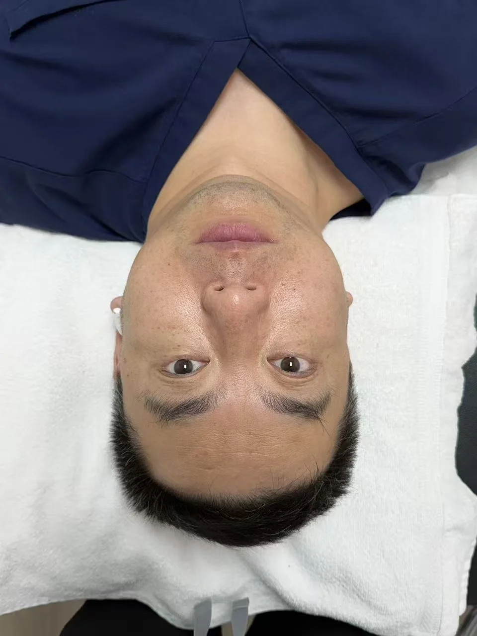 Facial Rejuvenation Acupuncture 