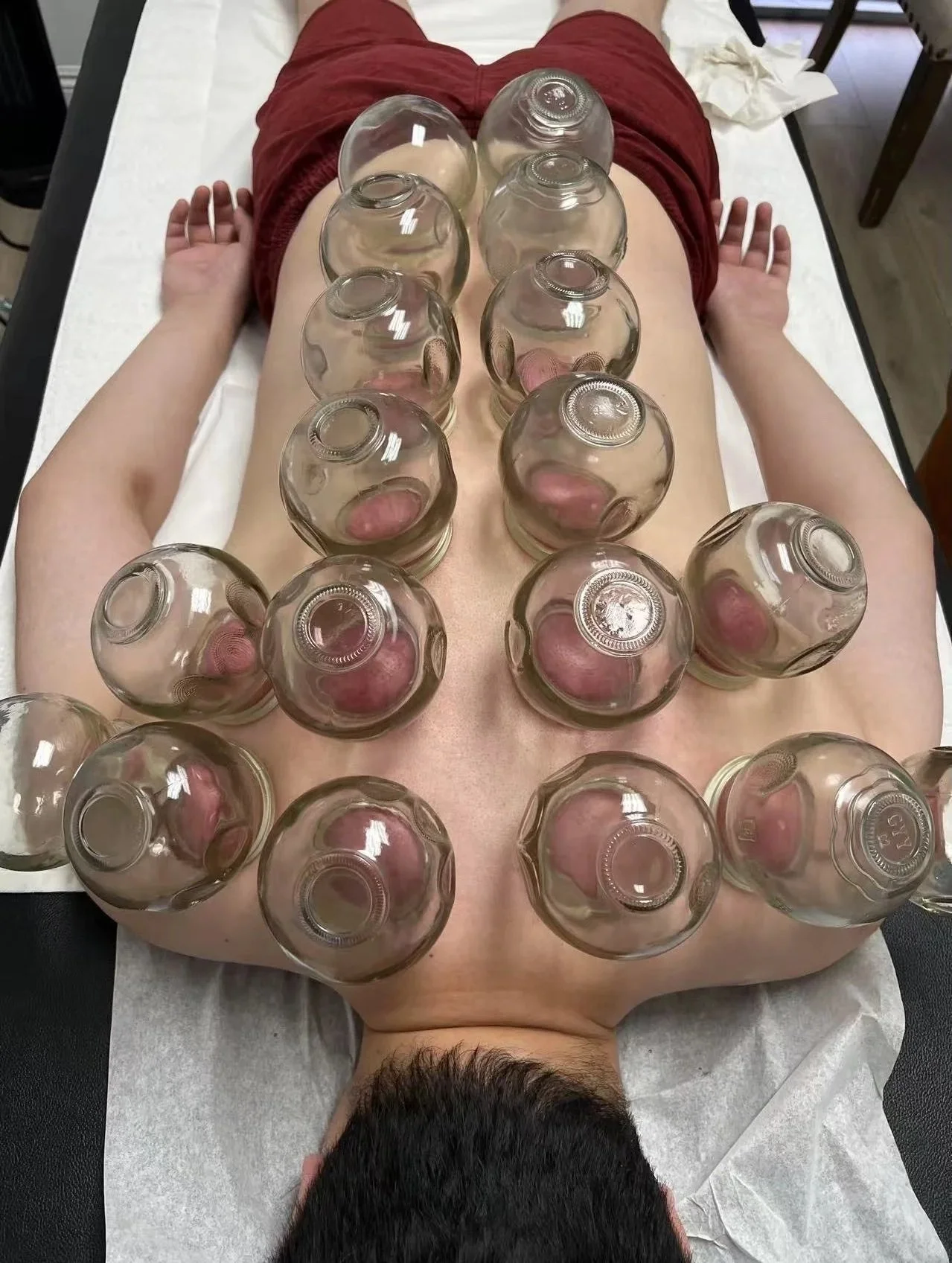 Fire Cupping 