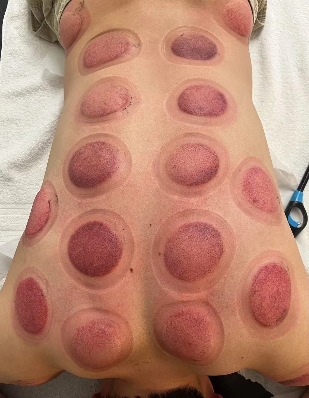 Fire Cupping 