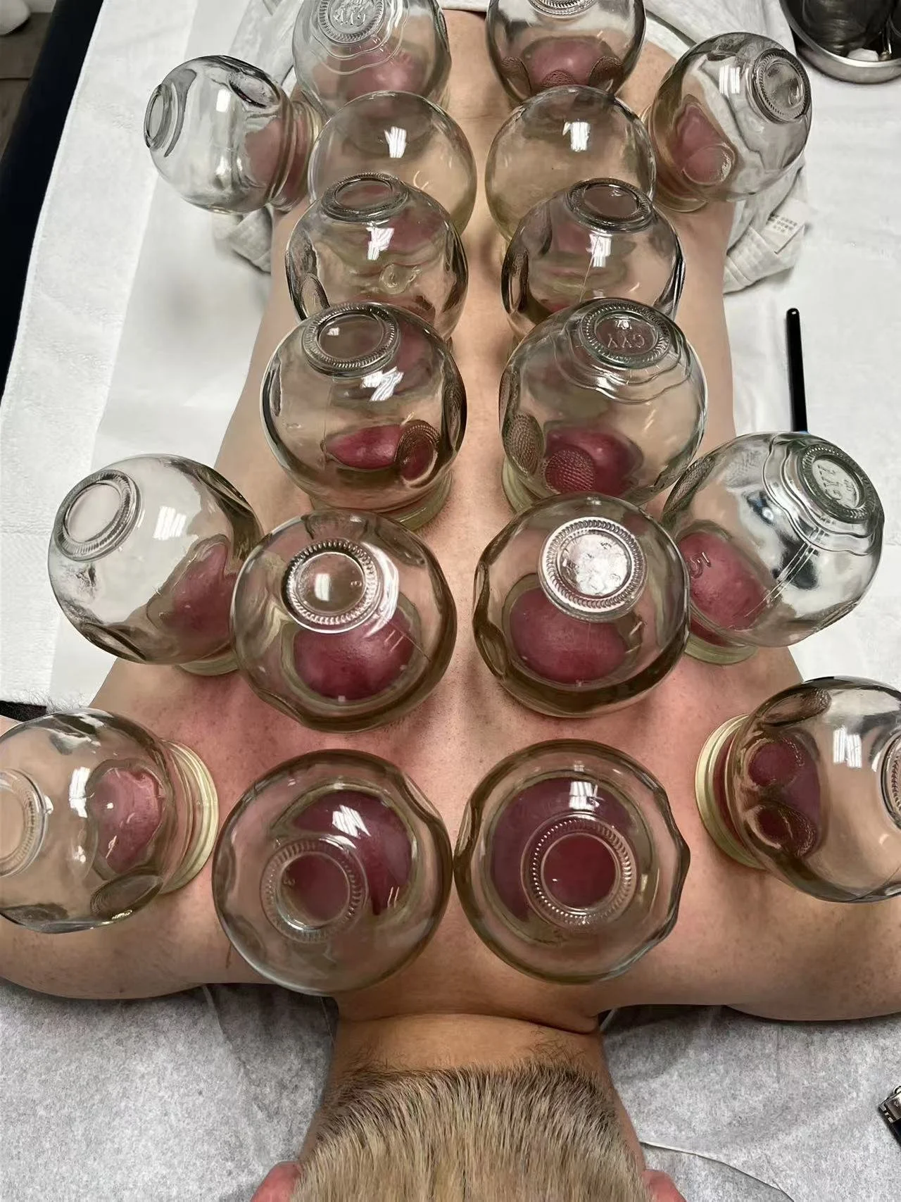 Fire Cupping 