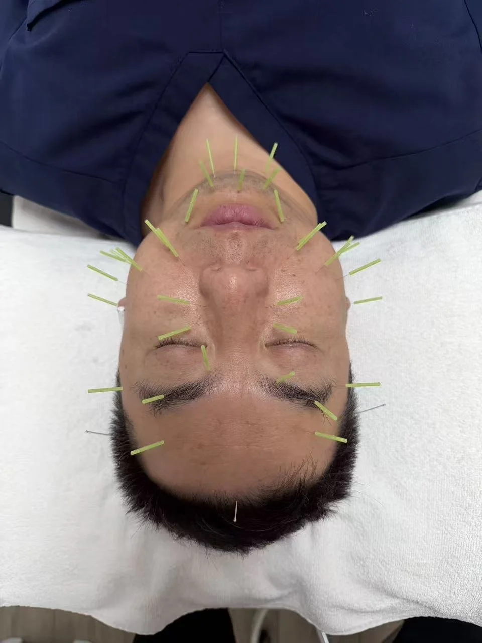 Facial Rejuvenation Acupuncture 