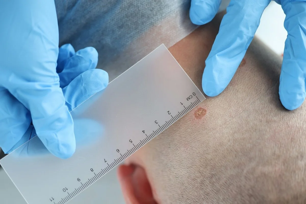 Doctor evaluating a mole using the ABCDE rule for skin cancer early detection