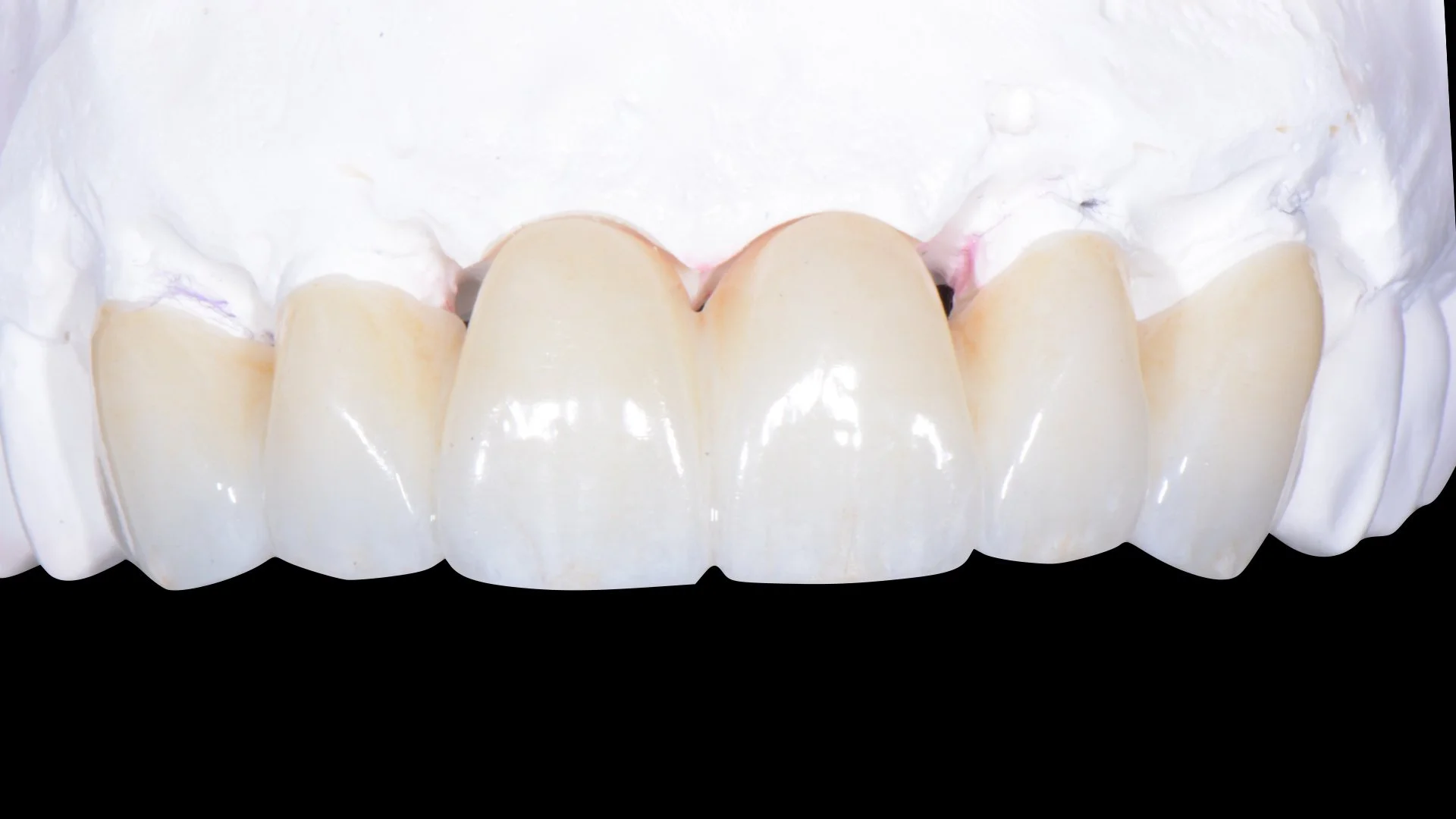 Crown & bridge case.