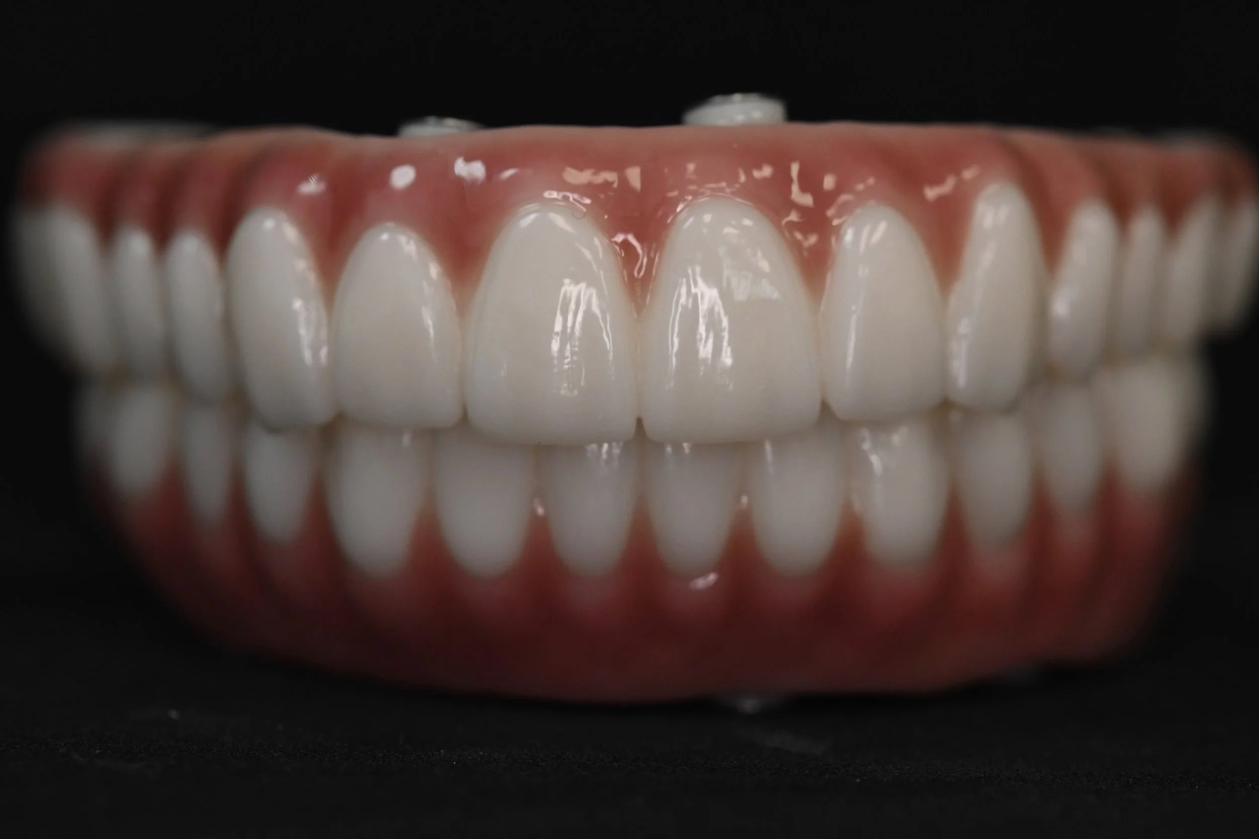 All-on-X full-arch zirconia with layered gingiva and stain & glaze.