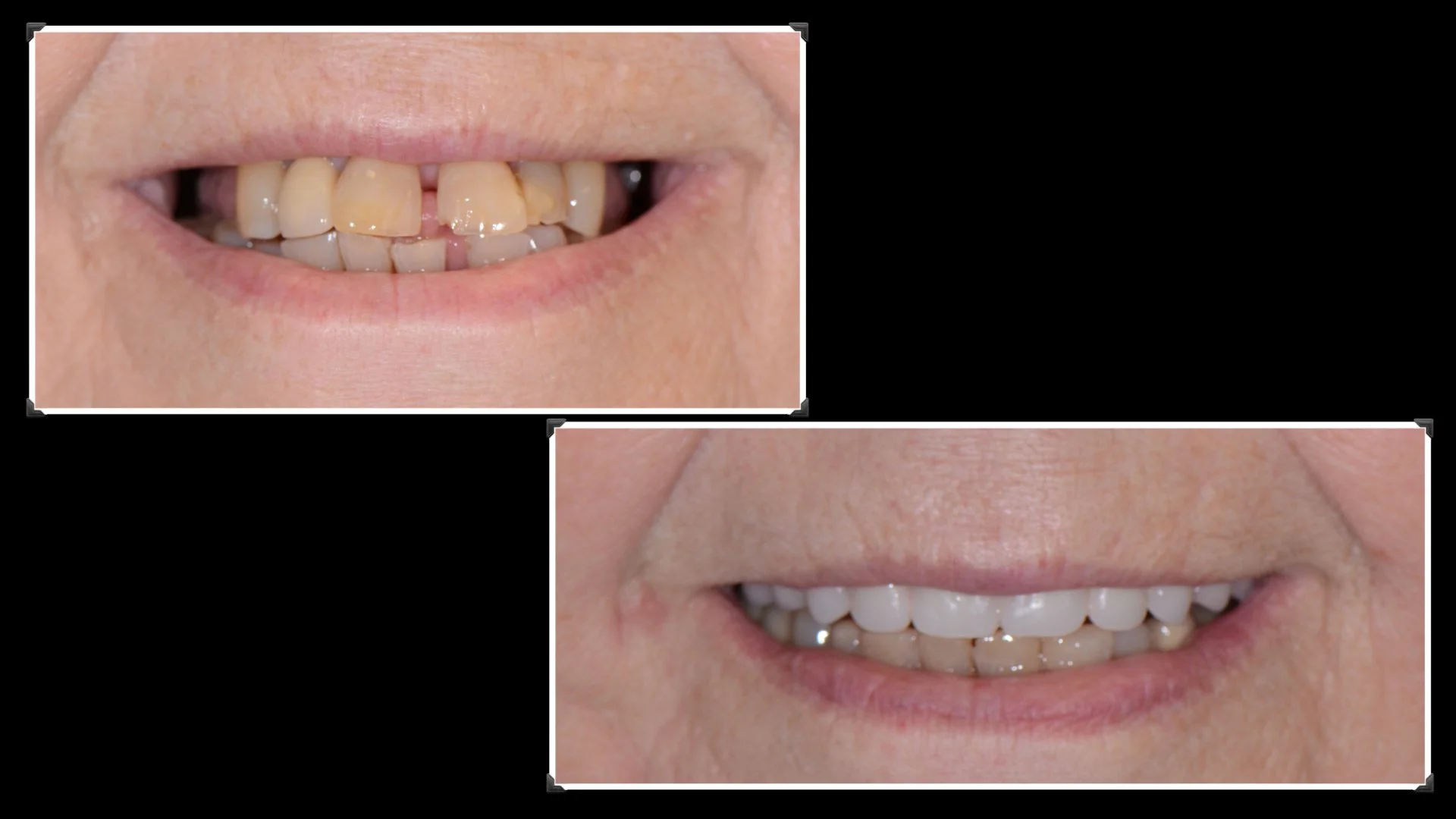 2 unit crown case. Full zirconia contour. 