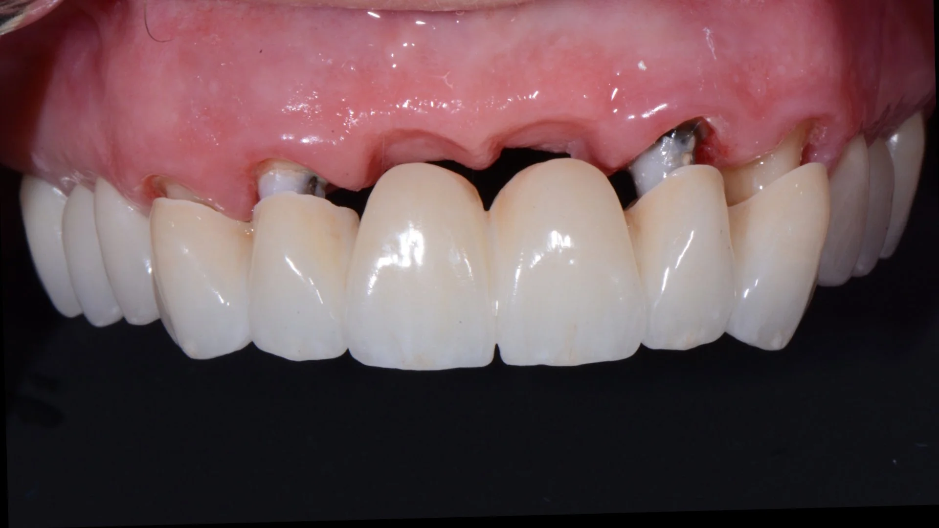 Crown & bridge case.