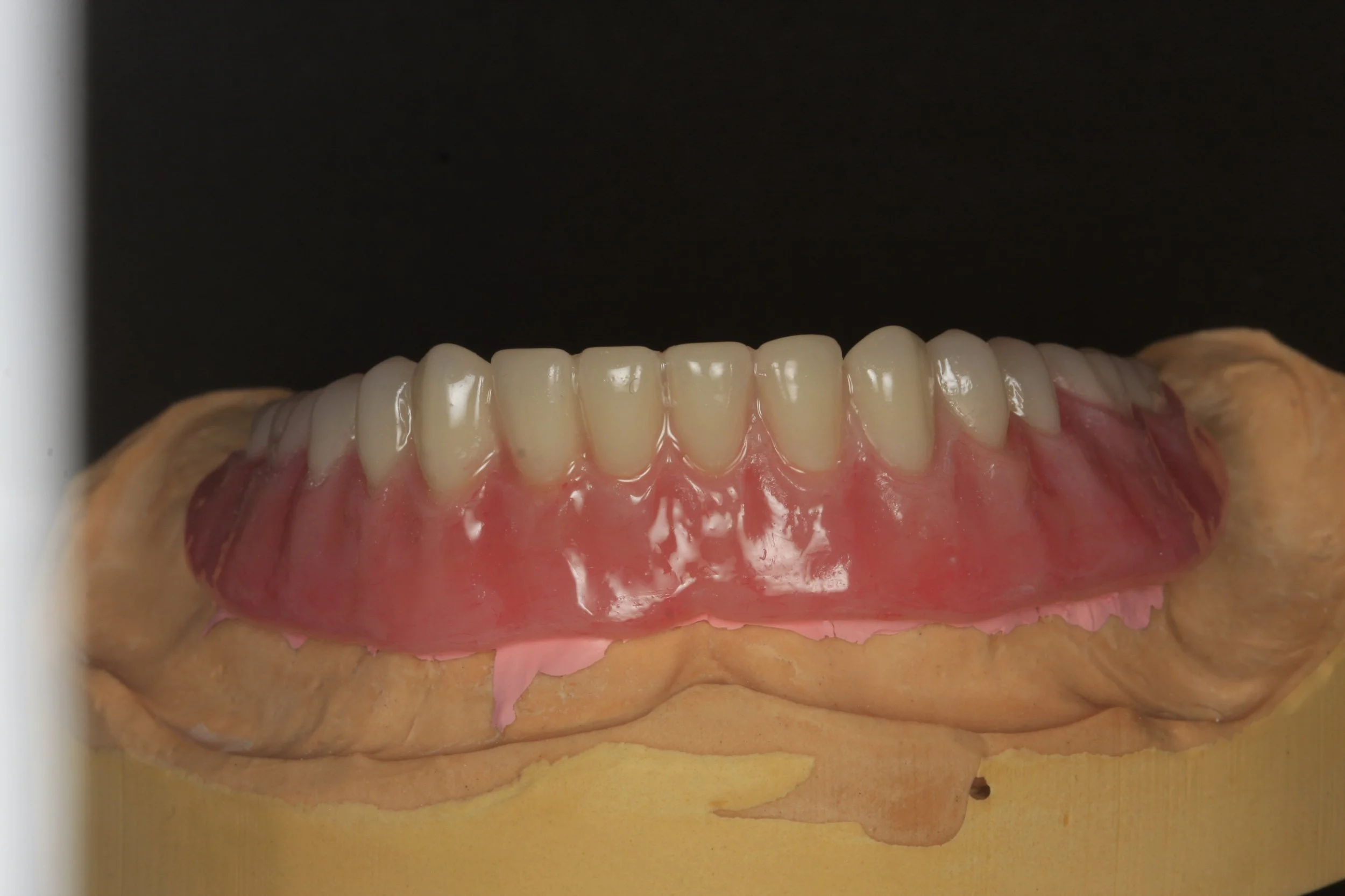 Crealock abutments with overdenture