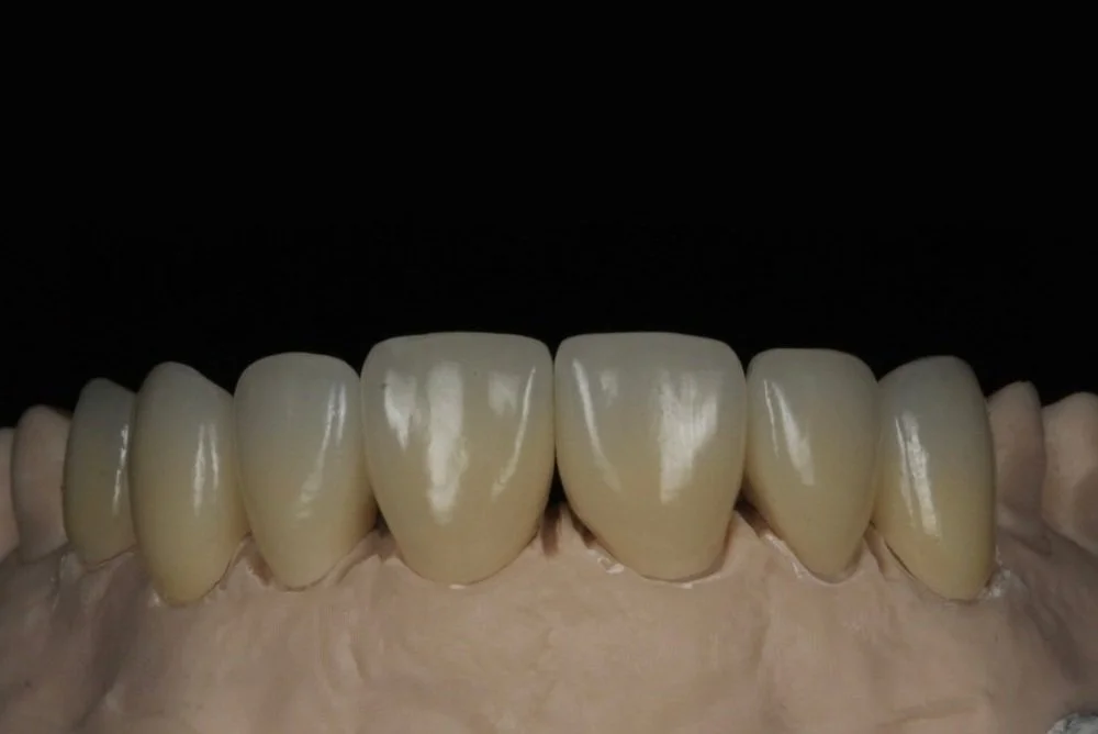 Close-up of a set of artificial teeth on a dental model