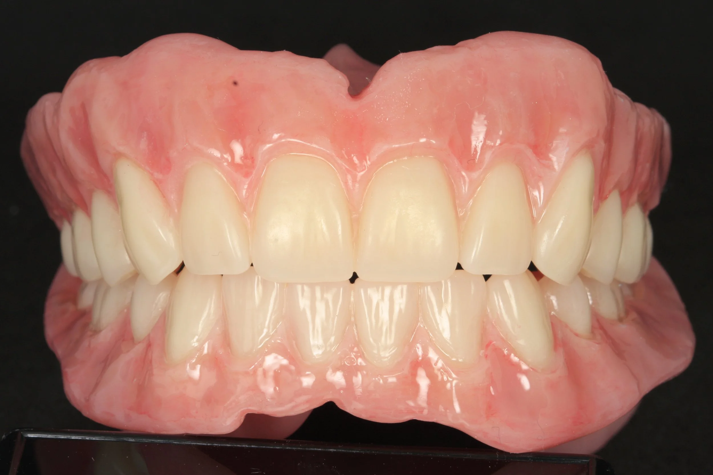 Full denture with Ivoclar phonares and nexco finish2