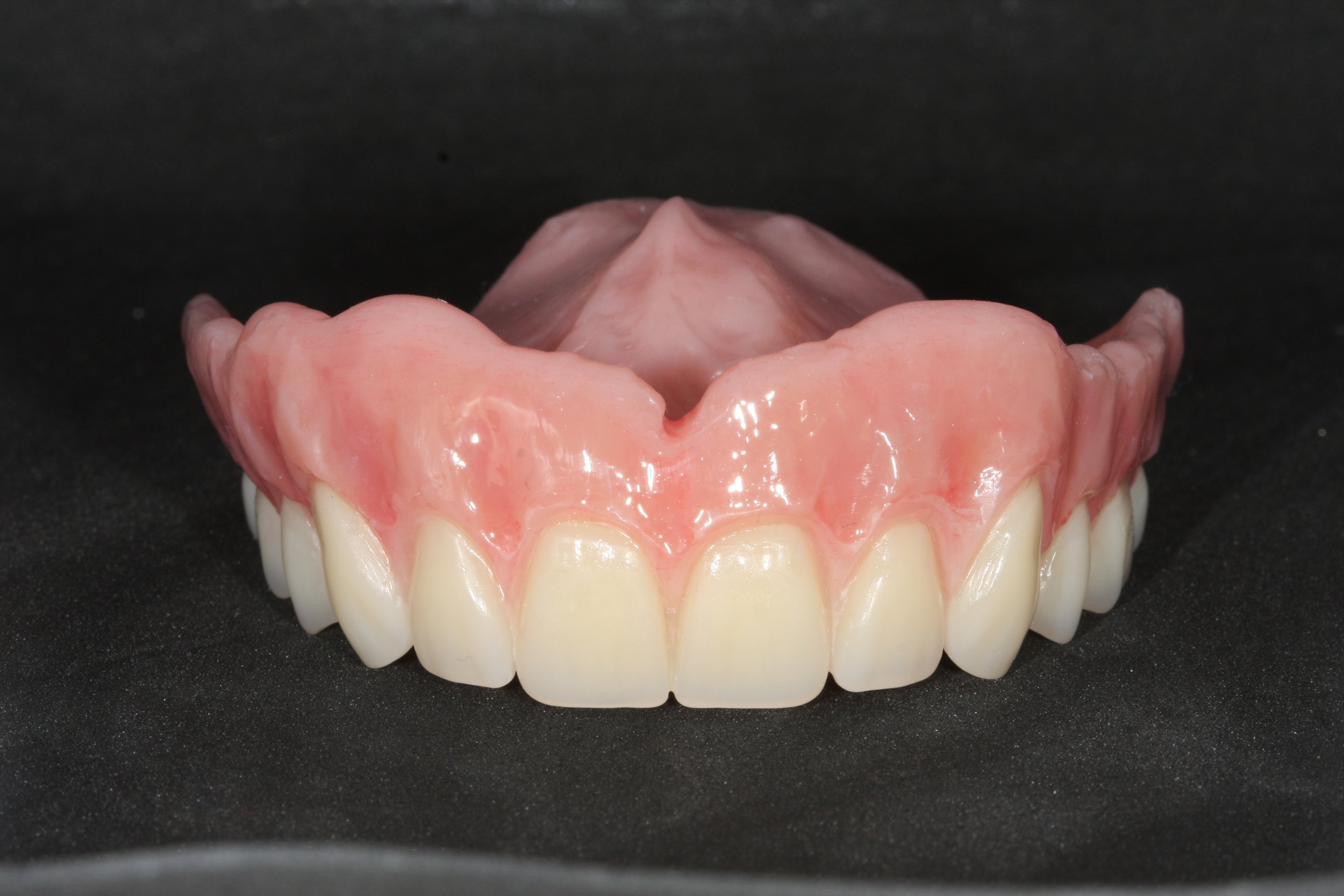 Denture with Ivoclar phonares and nexco finish2