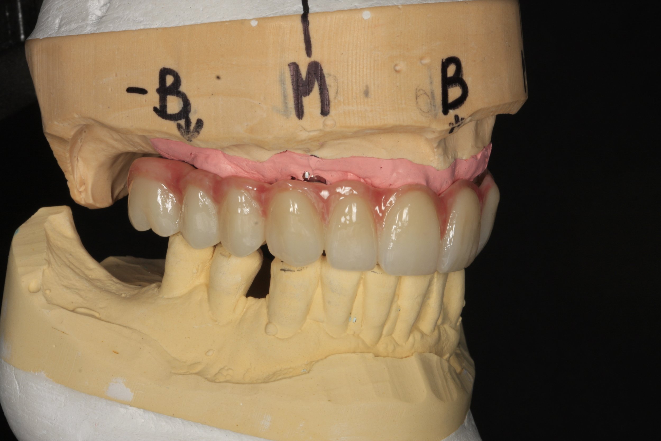 Right hand side zirconia finish