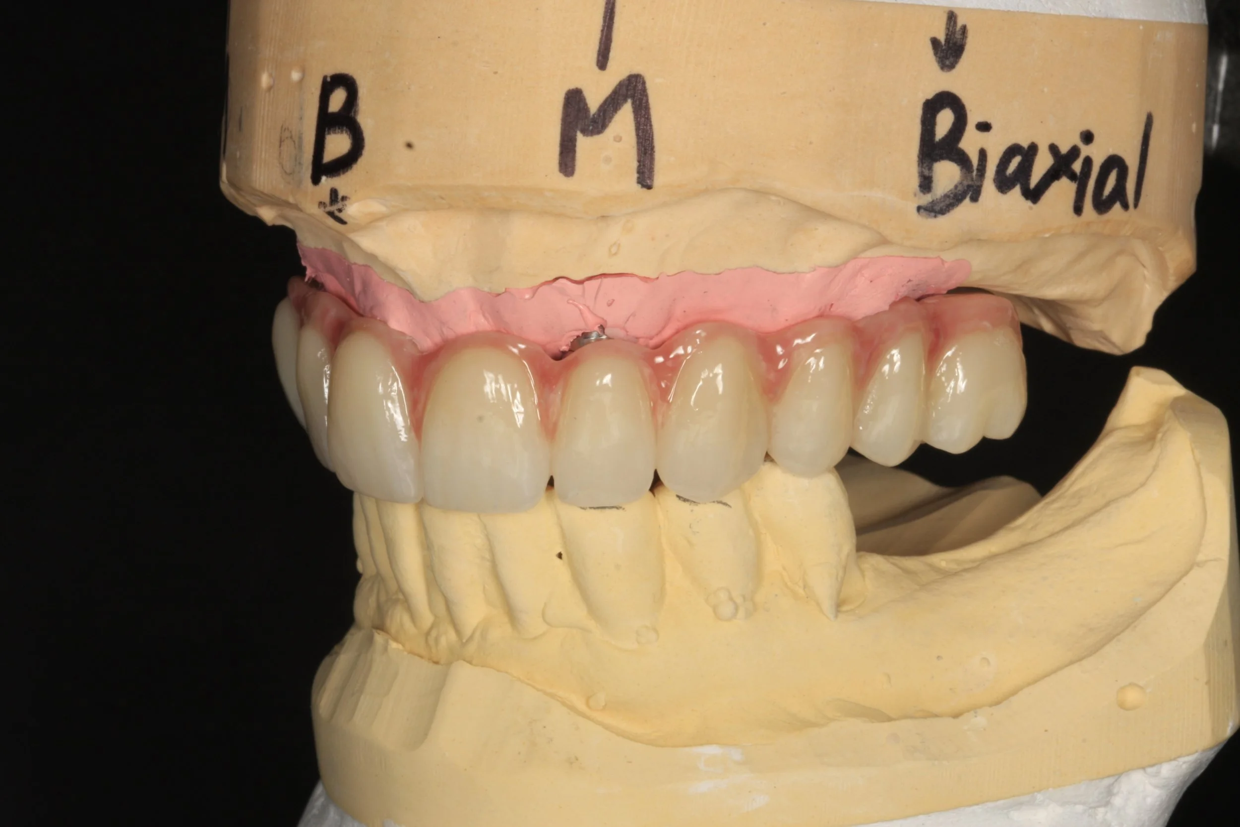 Left hand side zirconia finish