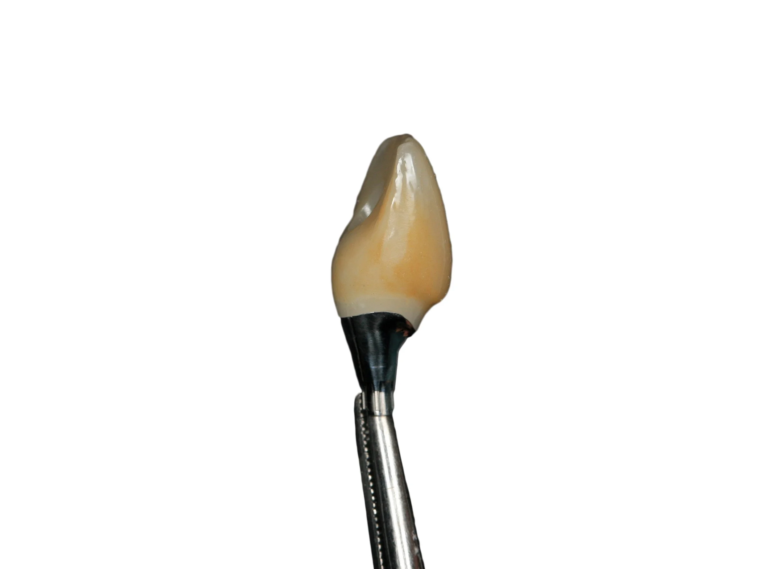 Dental crown attached to a dental implant on a metal-handled tool against a white background.