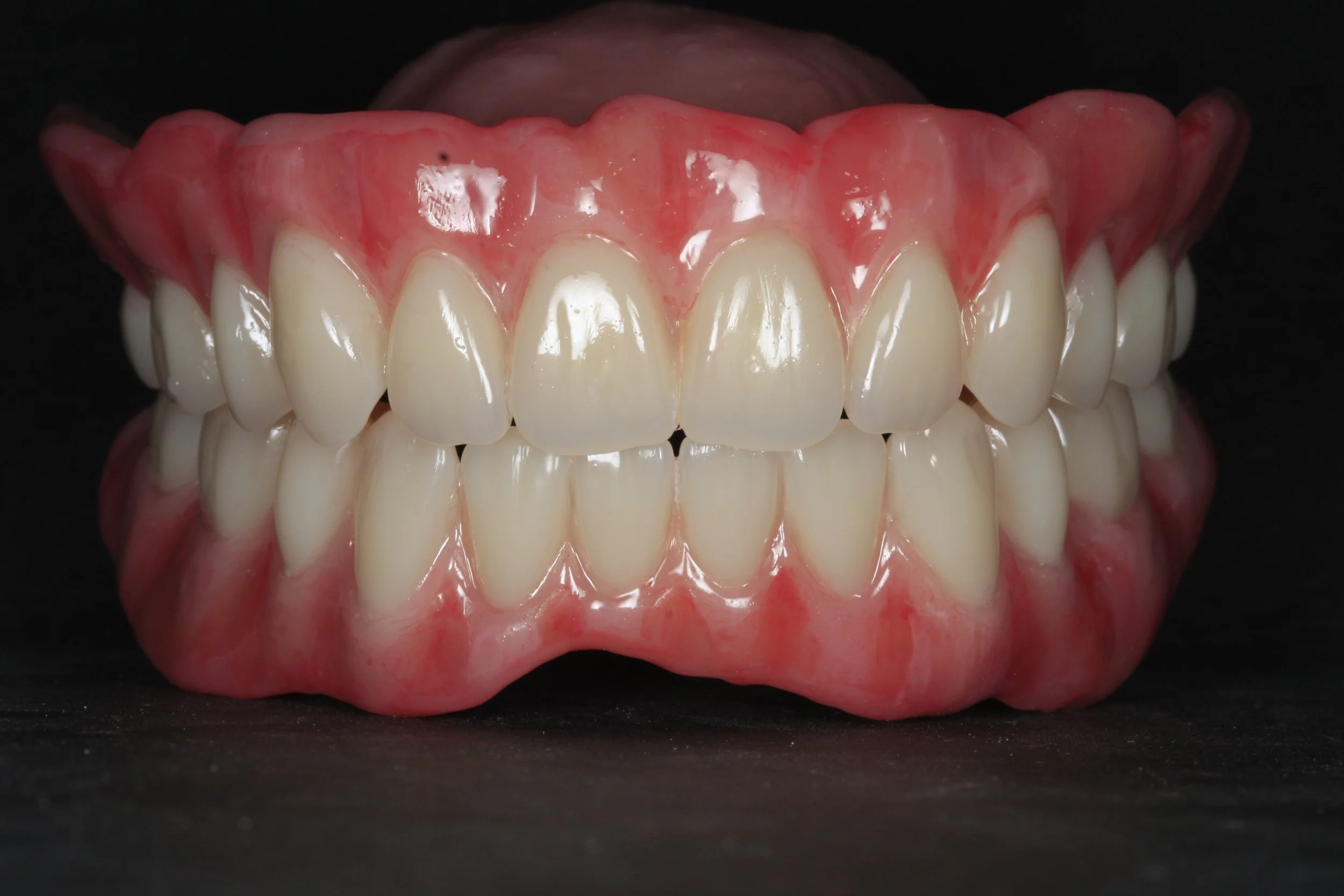 Full denture with Ivoclar phonares and nexco finish