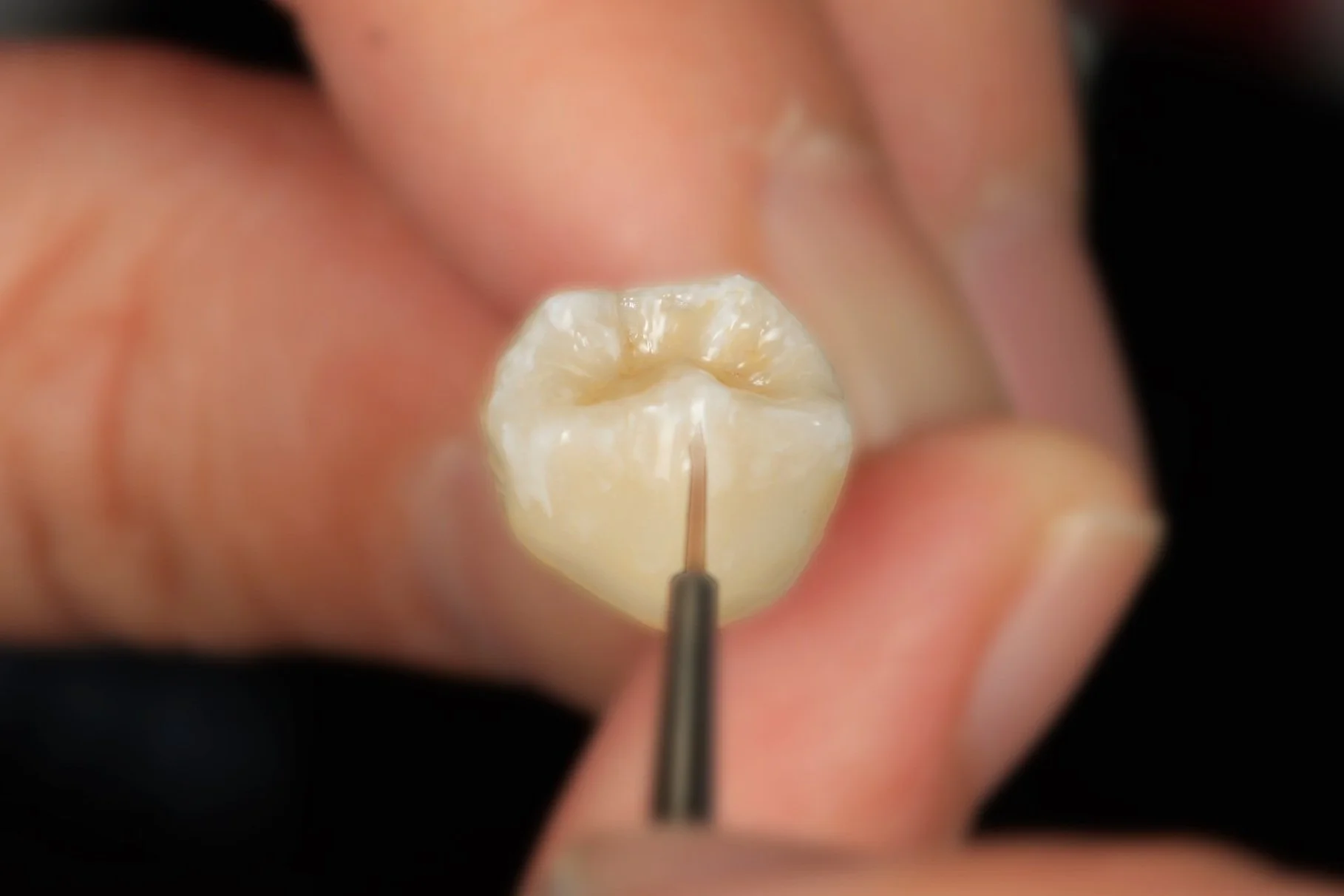 Close-up of a dental procedure on a molar tooth with a dental tool in use.