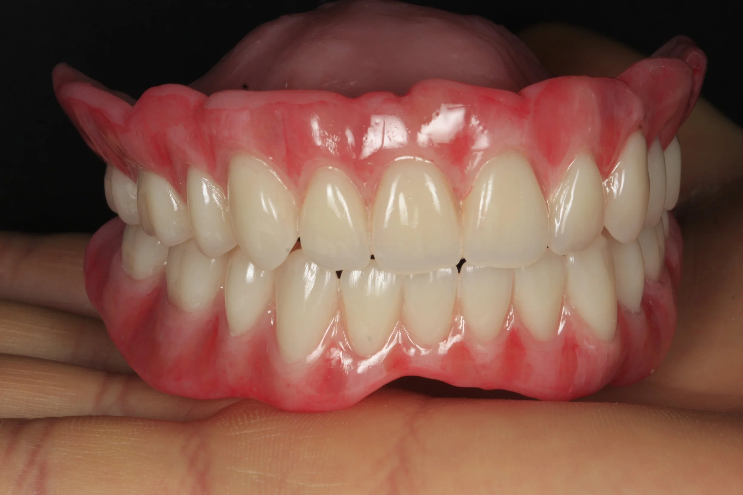 Full denture with Ivoclar phonares and nexco finish